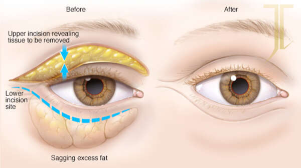 blefaroplastia_2