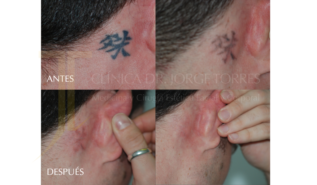 Eliminación de Tatuajes - Tattoo -Medicina y Cirugía Estética Facial y Corporal en Valencia Dr. Jorge Torres