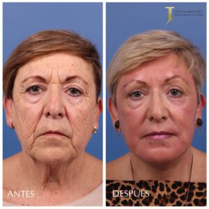 Ejemplo de Peeling Profundo + Lifting Facial Dr. Torres