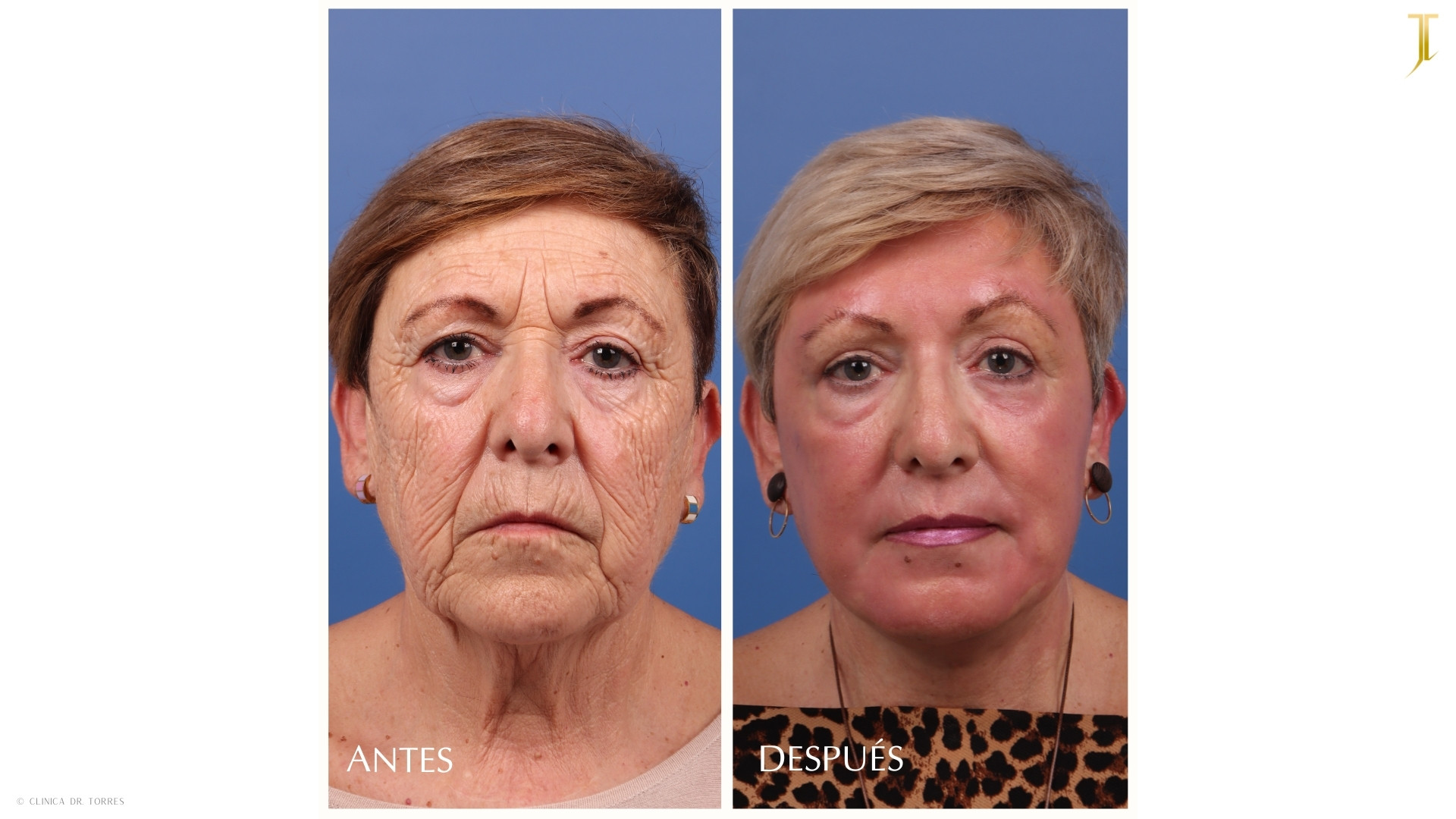 Peeling Profundo. Medicina y Cirugía Estética Facial y Corporal en Valencia Dr. Jorge Torres