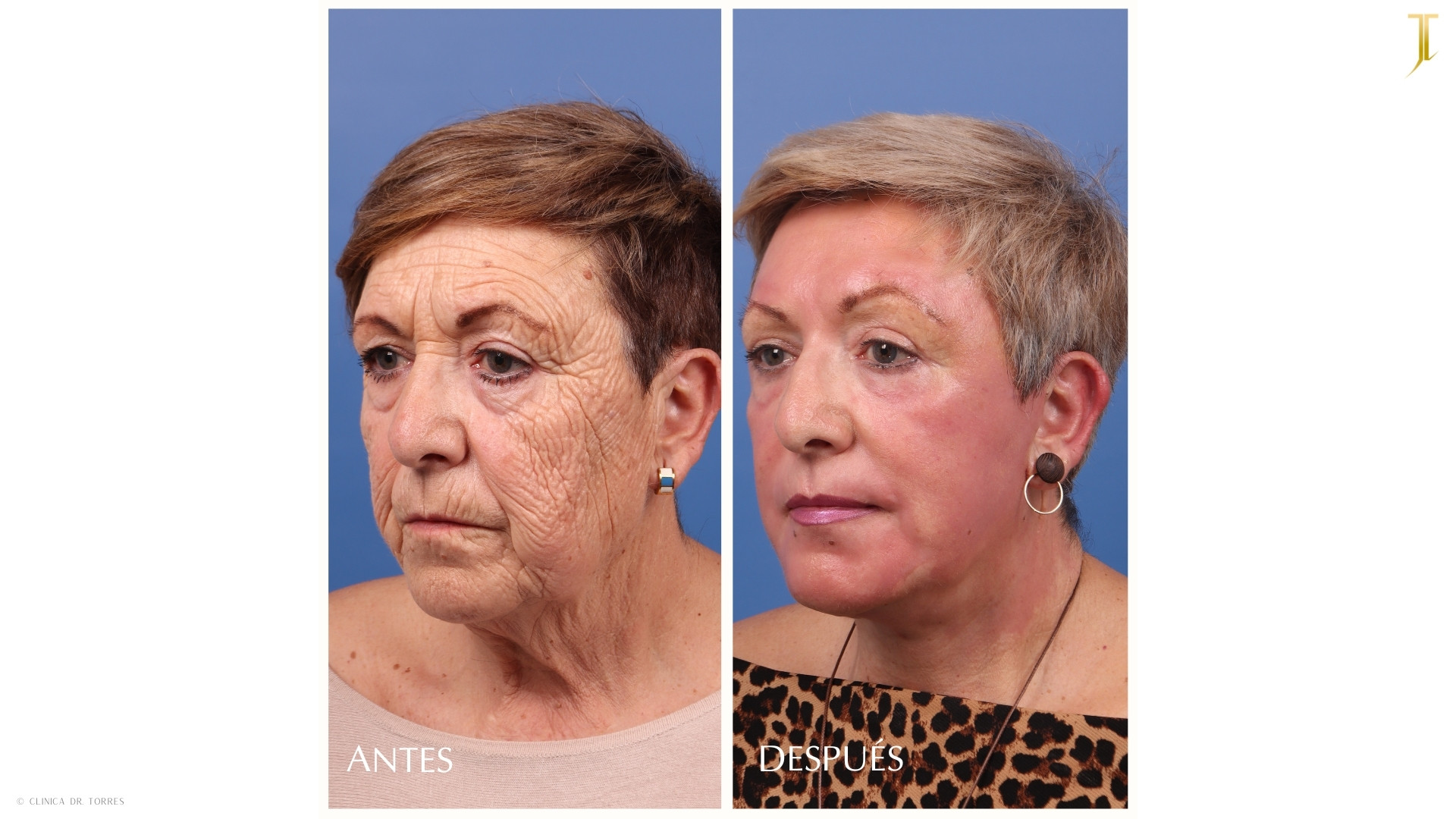 Peeling Profundo. Medicina y Cirugía Estética Facial y Corporal en Valencia Dr. Jorge Torres