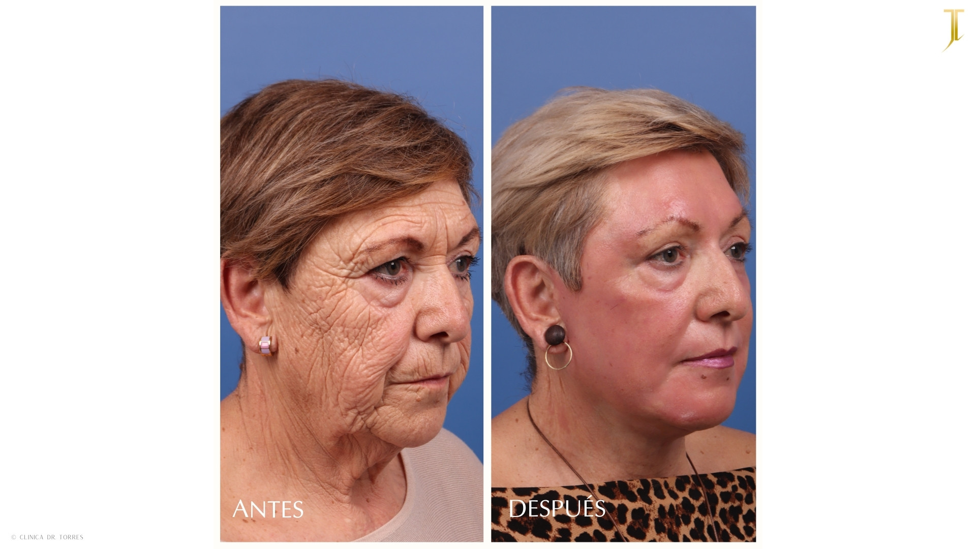 Peeling Profundo. Medicina y Cirugía Estética Facial y Corporal en Valencia Dr. Jorge Torres