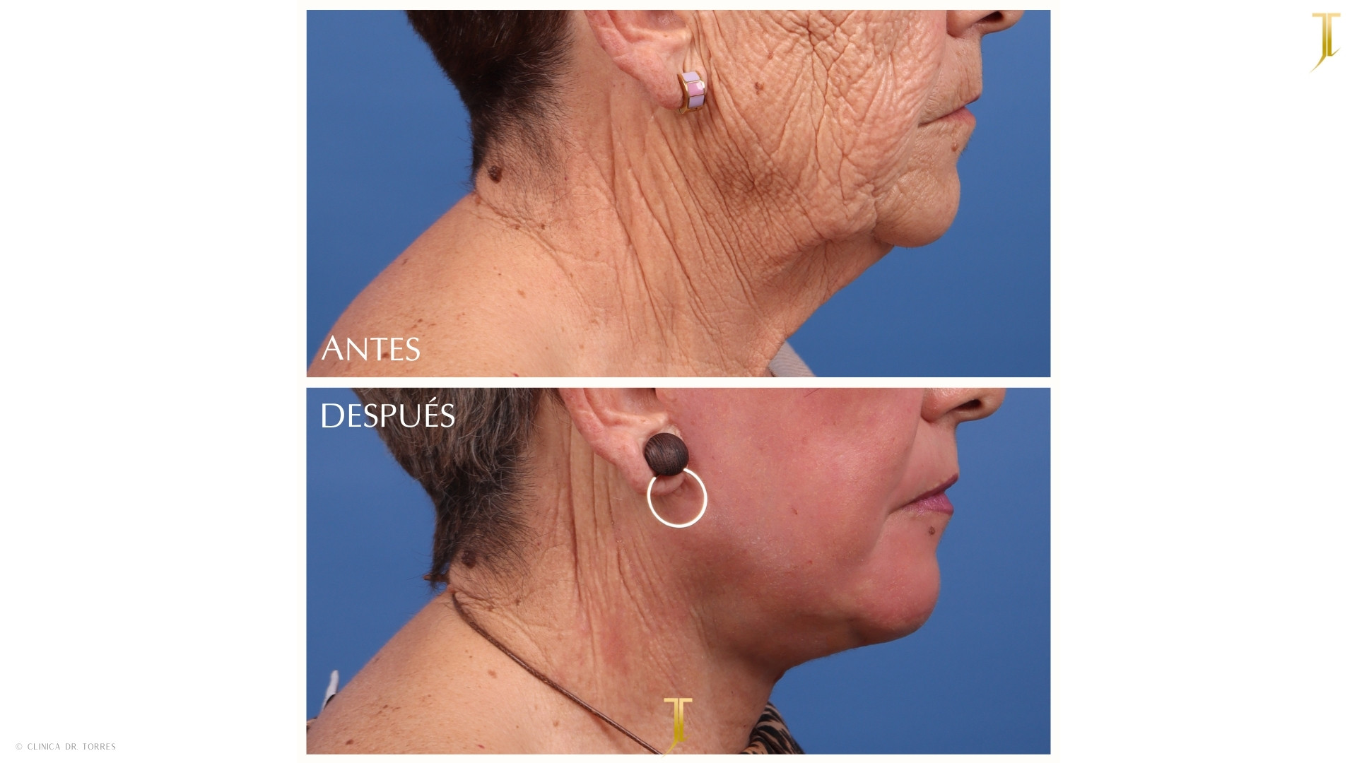 Peeling Profundo. Medicina y Cirugía Estética Facial y Corporal en Valencia Dr. Jorge Torres