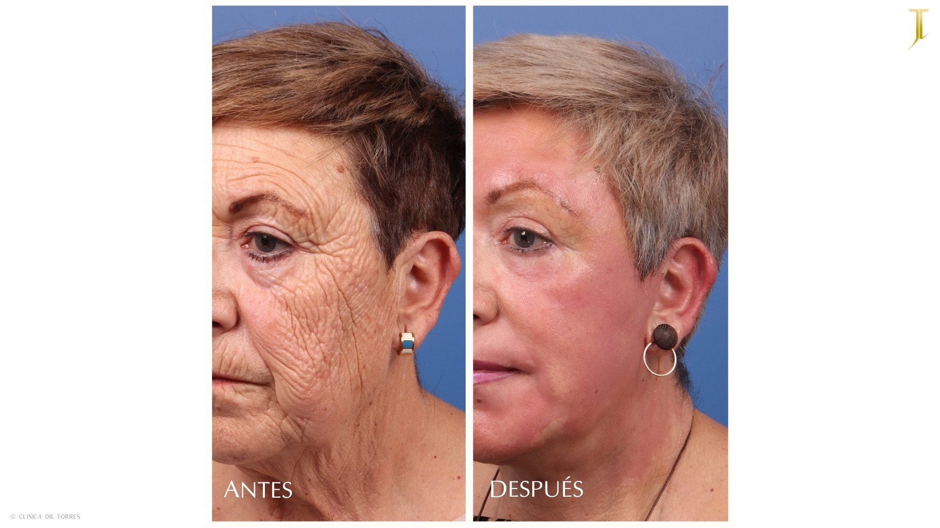 Peeling Profundo. Medicina y Cirugía Estética Facial y Corporal en Valencia Dr. Jorge Torres