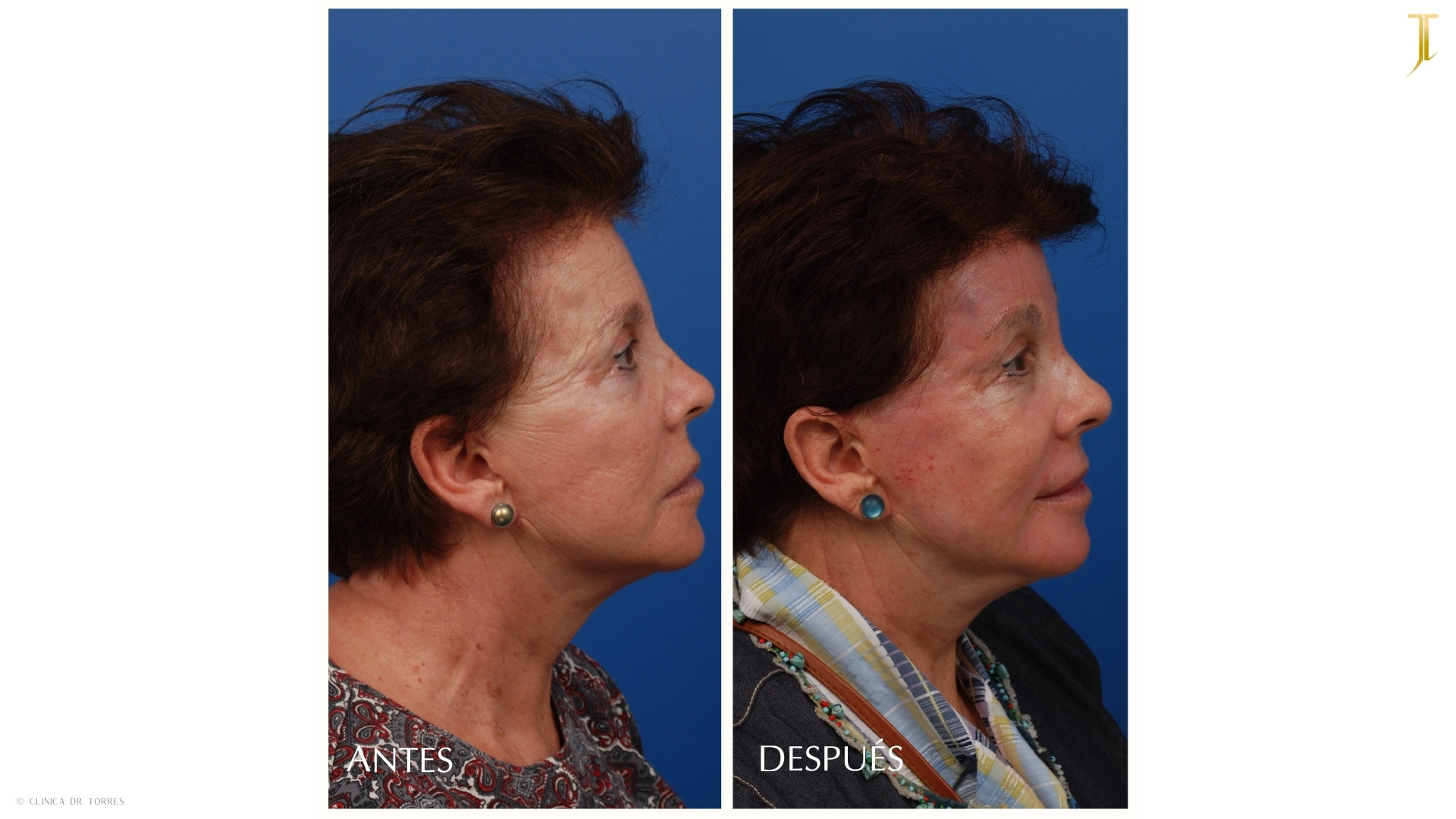 Peeling Profundo. Medicina y Cirugía Estética Facial y Corporal en Valencia Dr. Jorge Torres