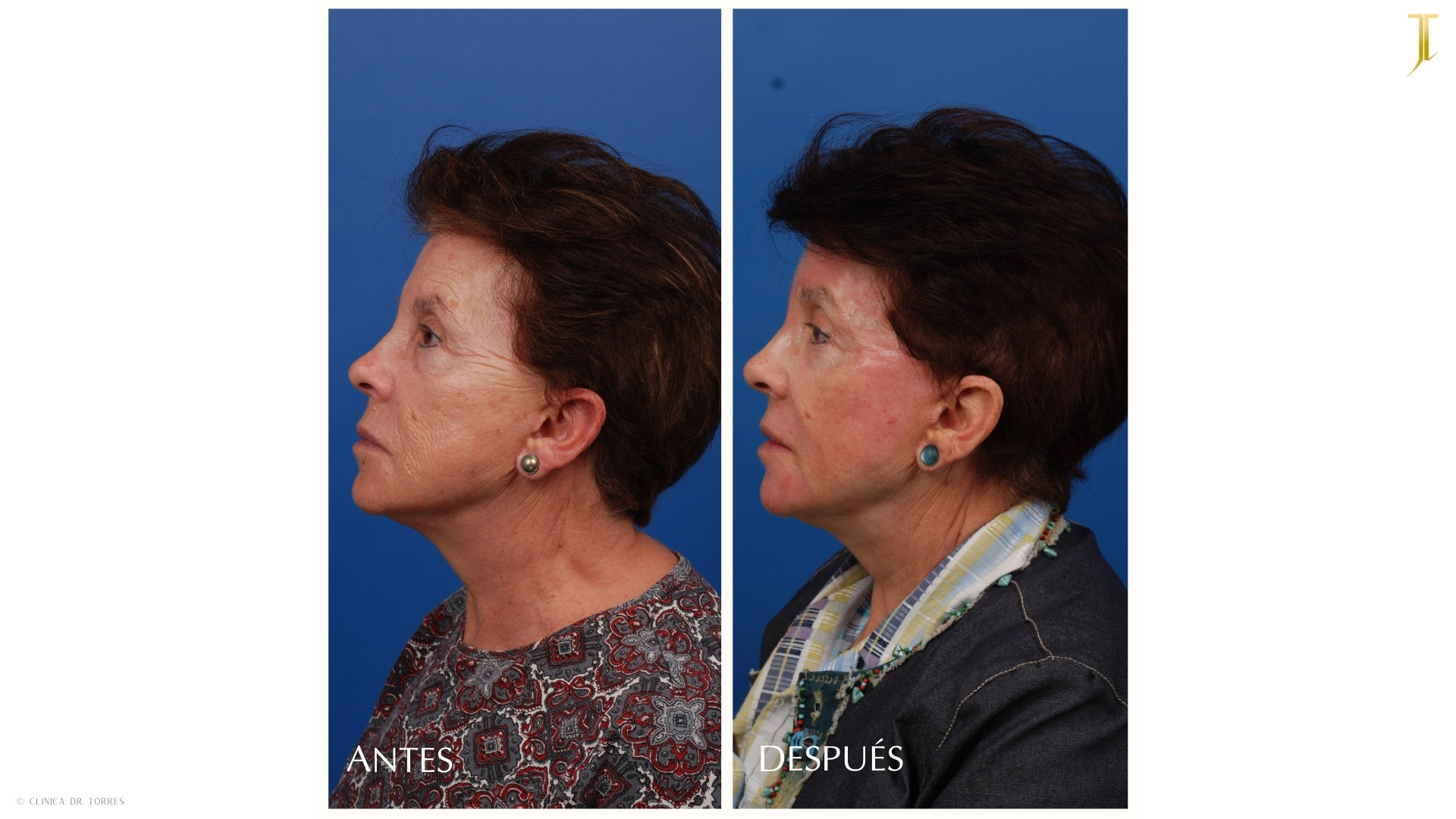 Peeling Profundo. Medicina y Cirugía Estética Facial y Corporal en Valencia Dr. Jorge Torres