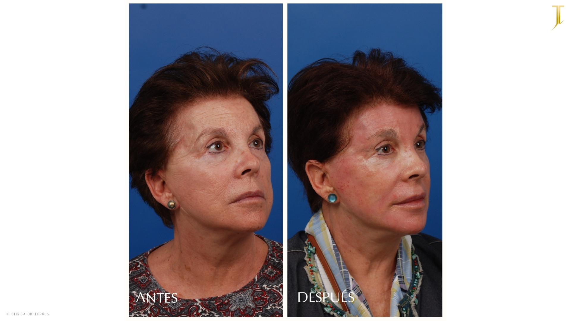 Peeling Profundo. Medicina y Cirugía Estética Facial y Corporal en Valencia Dr. Jorge Torres
