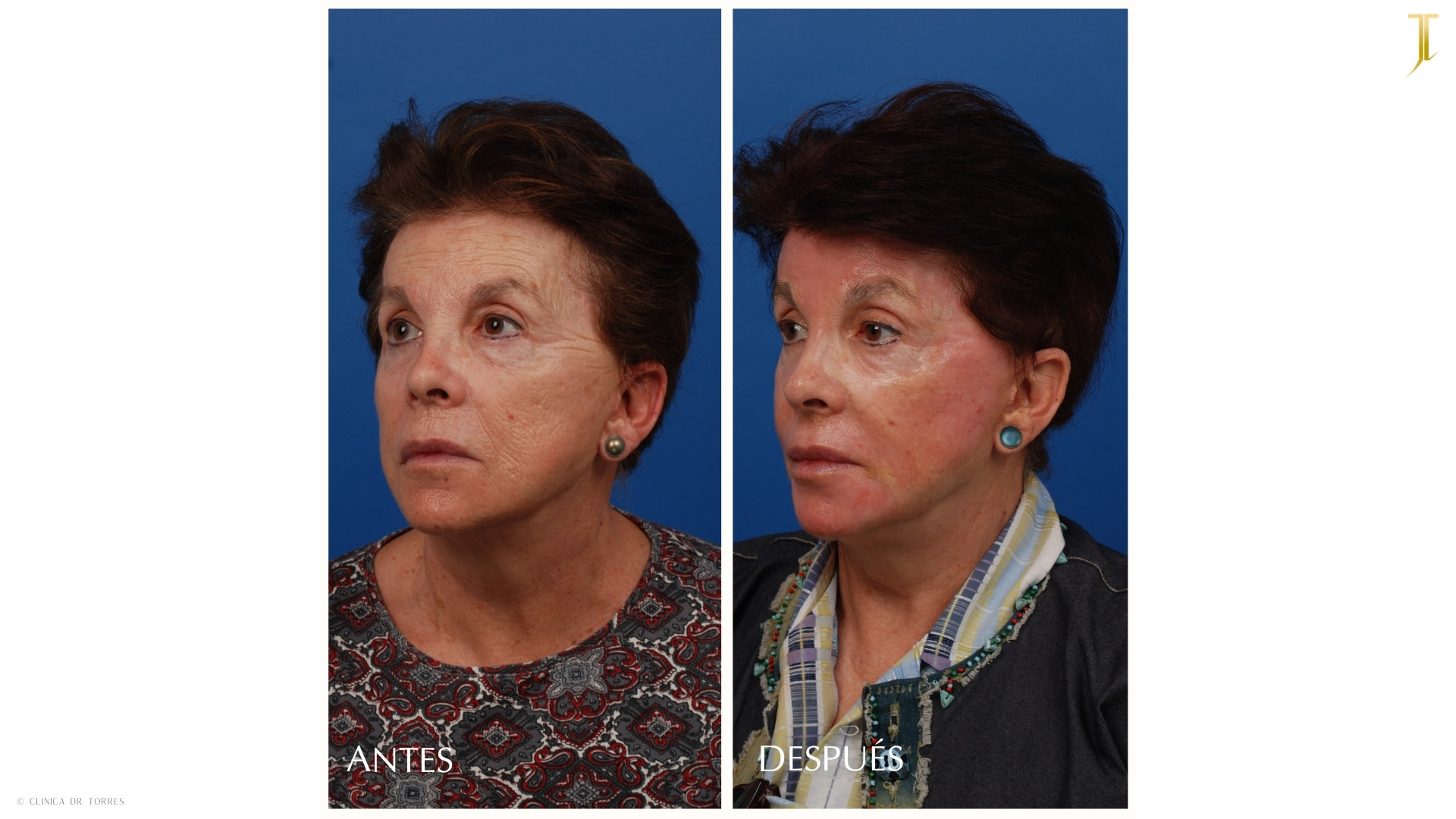 Peeling Profundo. Medicina y Cirugía Estética Facial y Corporal en Valencia Dr. Jorge Torres