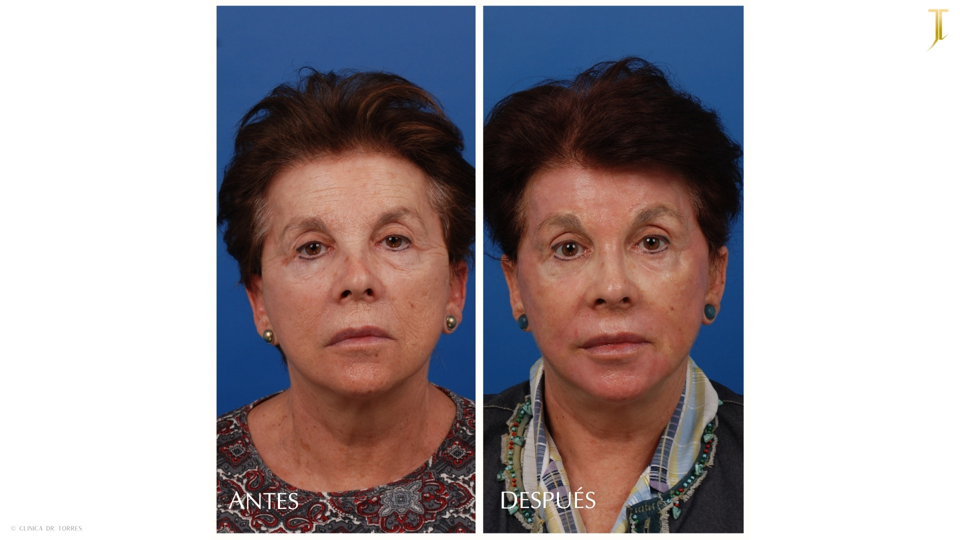 Peeling Profundo. Medicina y Cirugía Estética Facial y Corporal en Valencia Dr. Jorge Torres