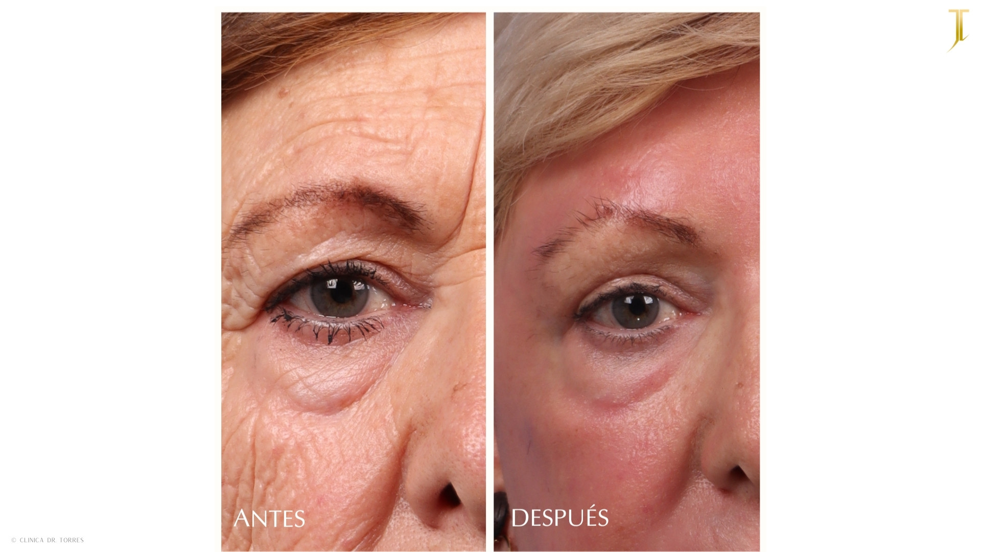 Peeling Profundo. Medicina y Cirugía Estética Facial y Corporal en Valencia Dr. Jorge Torres