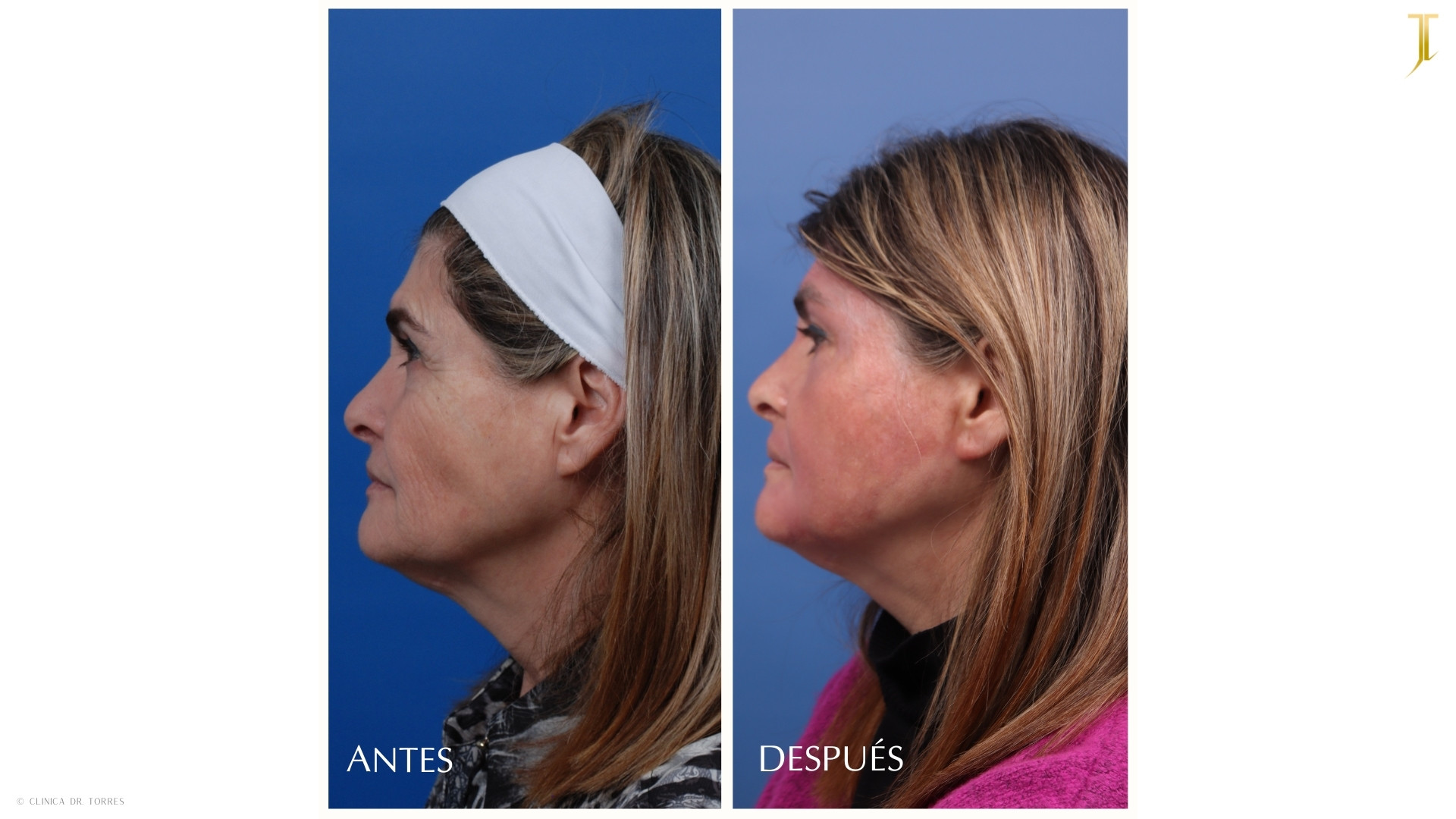 Peeling Profundo. Medicina y Cirugía Estética Facial y Corporal en Valencia Dr. Jorge Torres