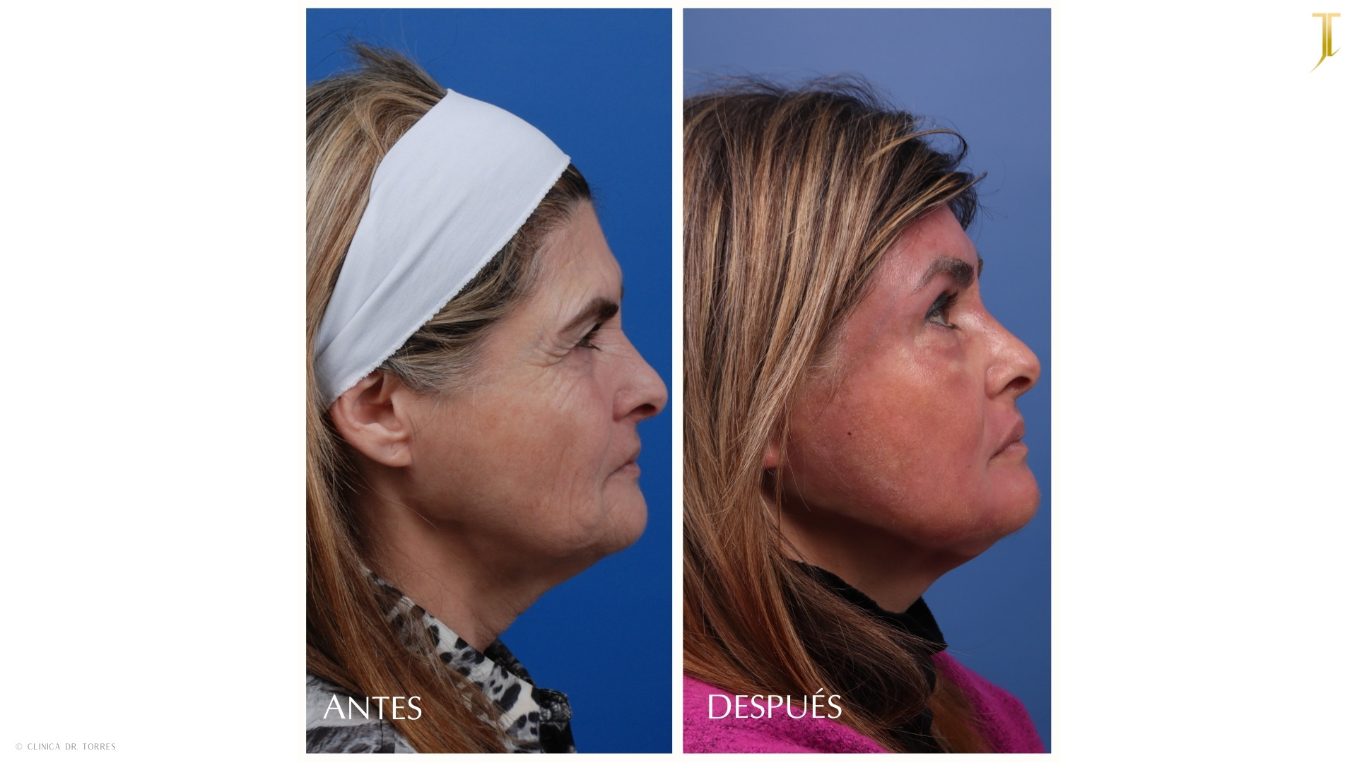 Peeling Profundo. Medicina y Cirugía Estética Facial y Corporal en Valencia Dr. Jorge Torres