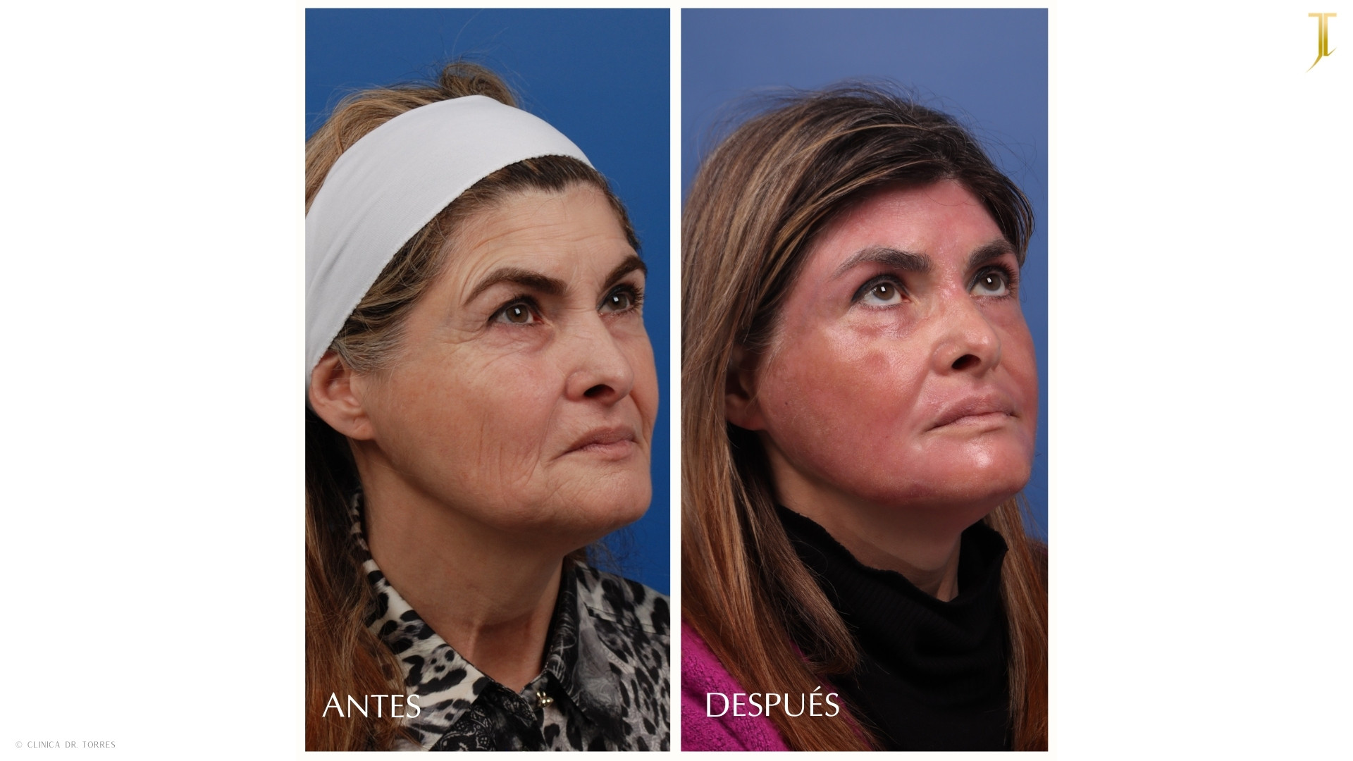 Peeling Profundo. Medicina y Cirugía Estética Facial y Corporal en Valencia Dr. Jorge Torres
