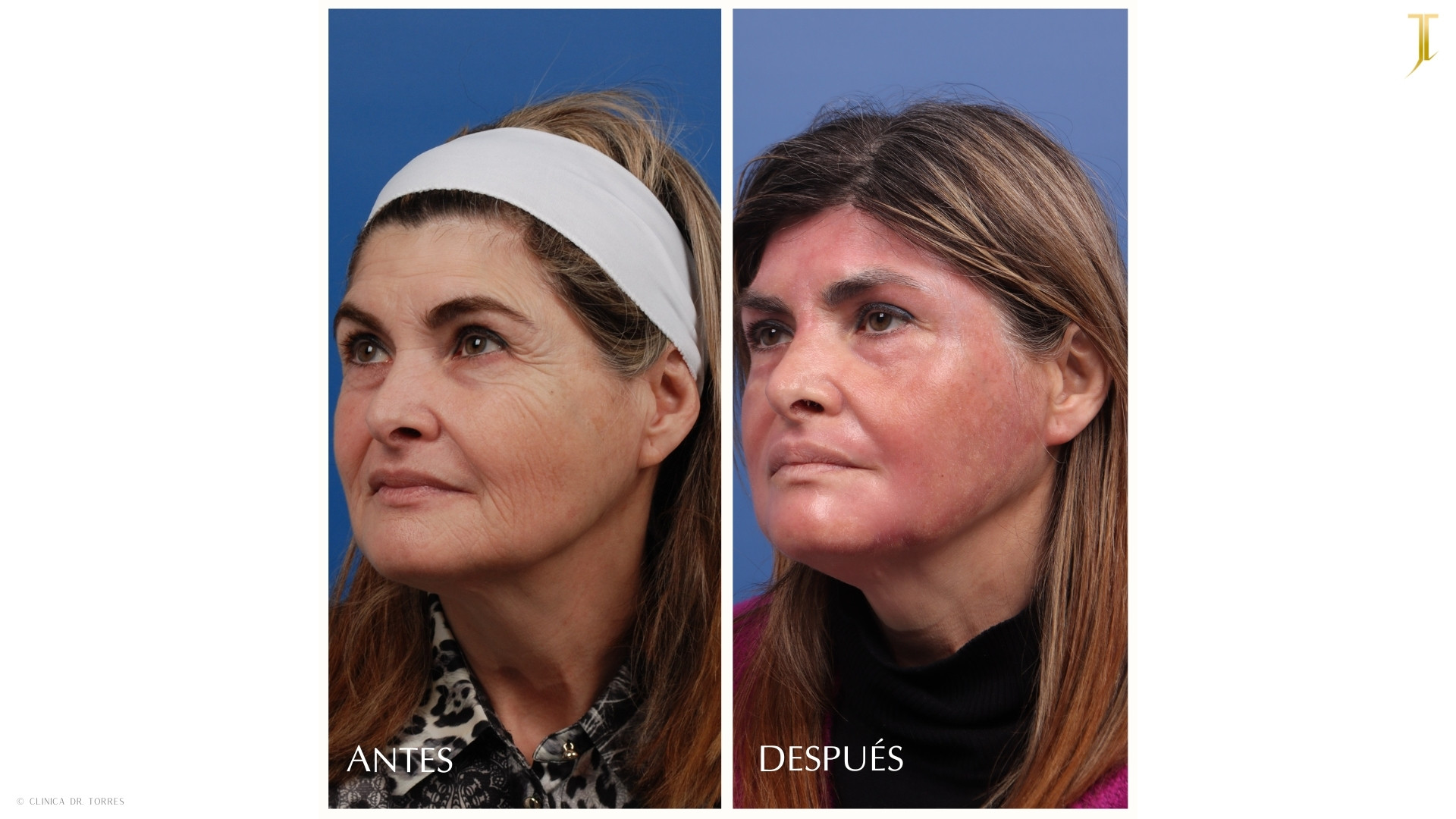 Peeling Profundo. Medicina y Cirugía Estética Facial y Corporal en Valencia Dr. Jorge Torres