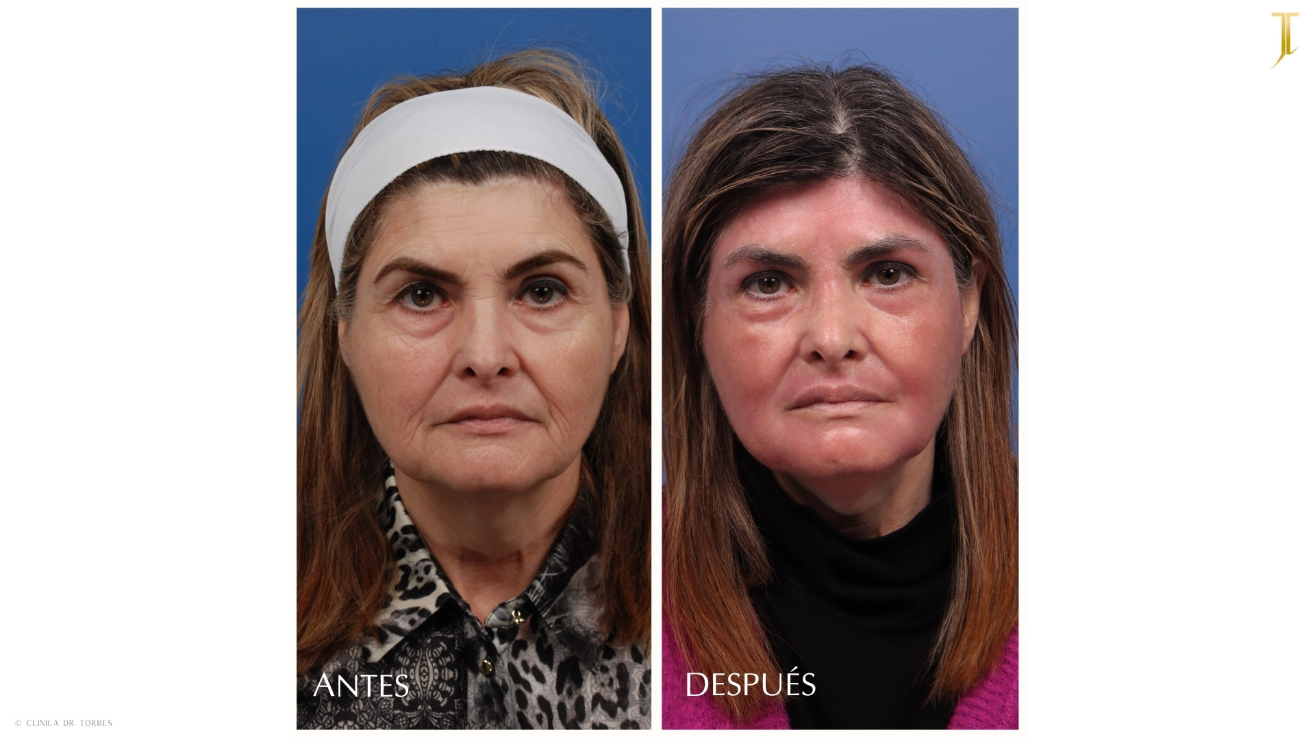 Peeling Profundo. Medicina y Cirugía Estética Facial y Corporal en Valencia Dr. Jorge Torres