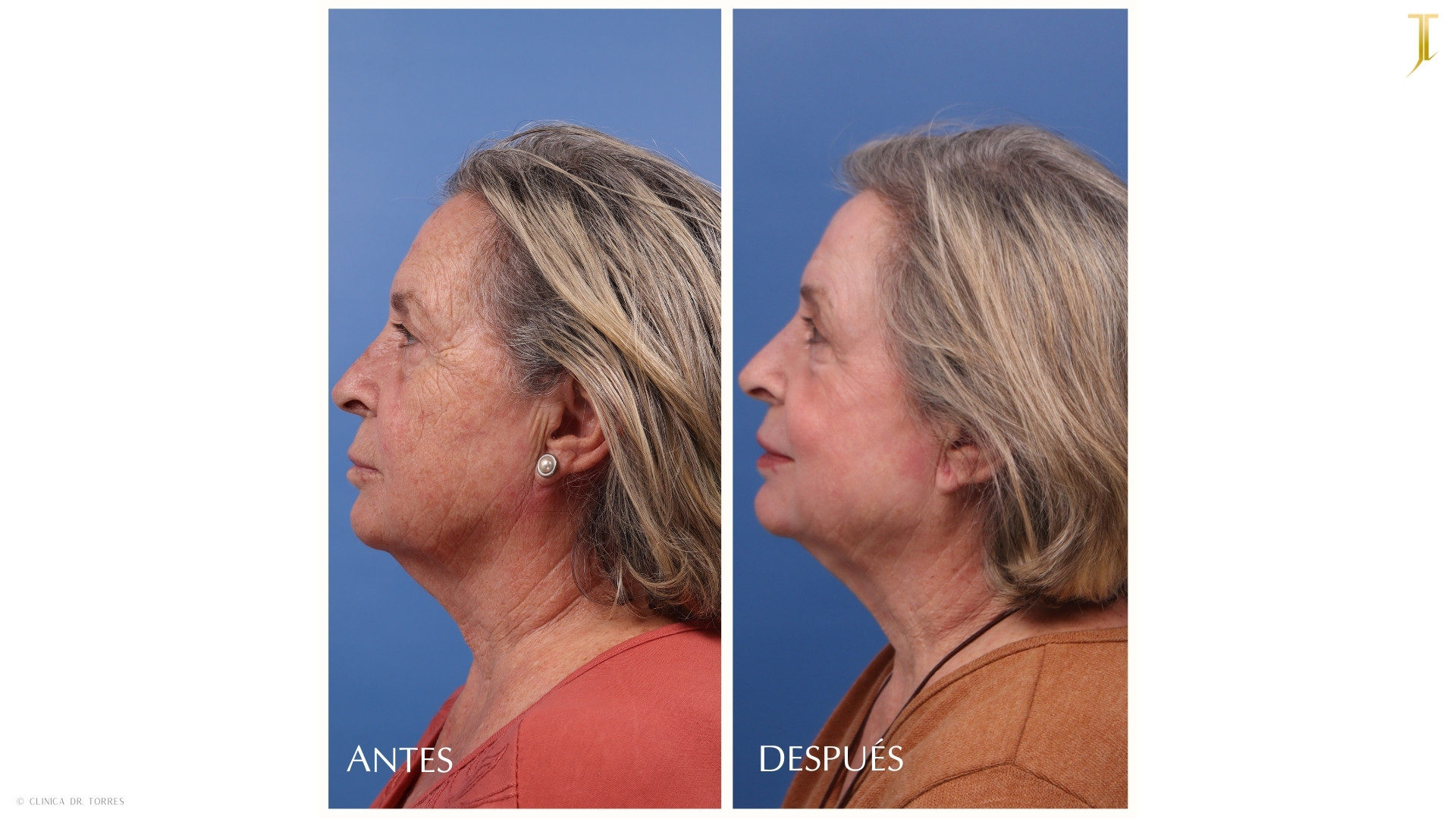 Peeling Profundo. Medicina y Cirugía Estética Facial y Corporal en Valencia Dr. Jorge Torres