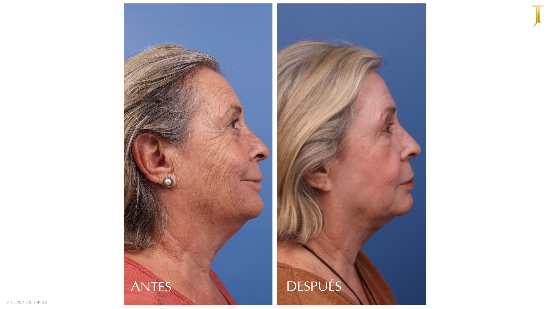 Peeling Profundo. Medicina y Cirugía Estética Facial y Corporal en Valencia Dr. Jorge Torres