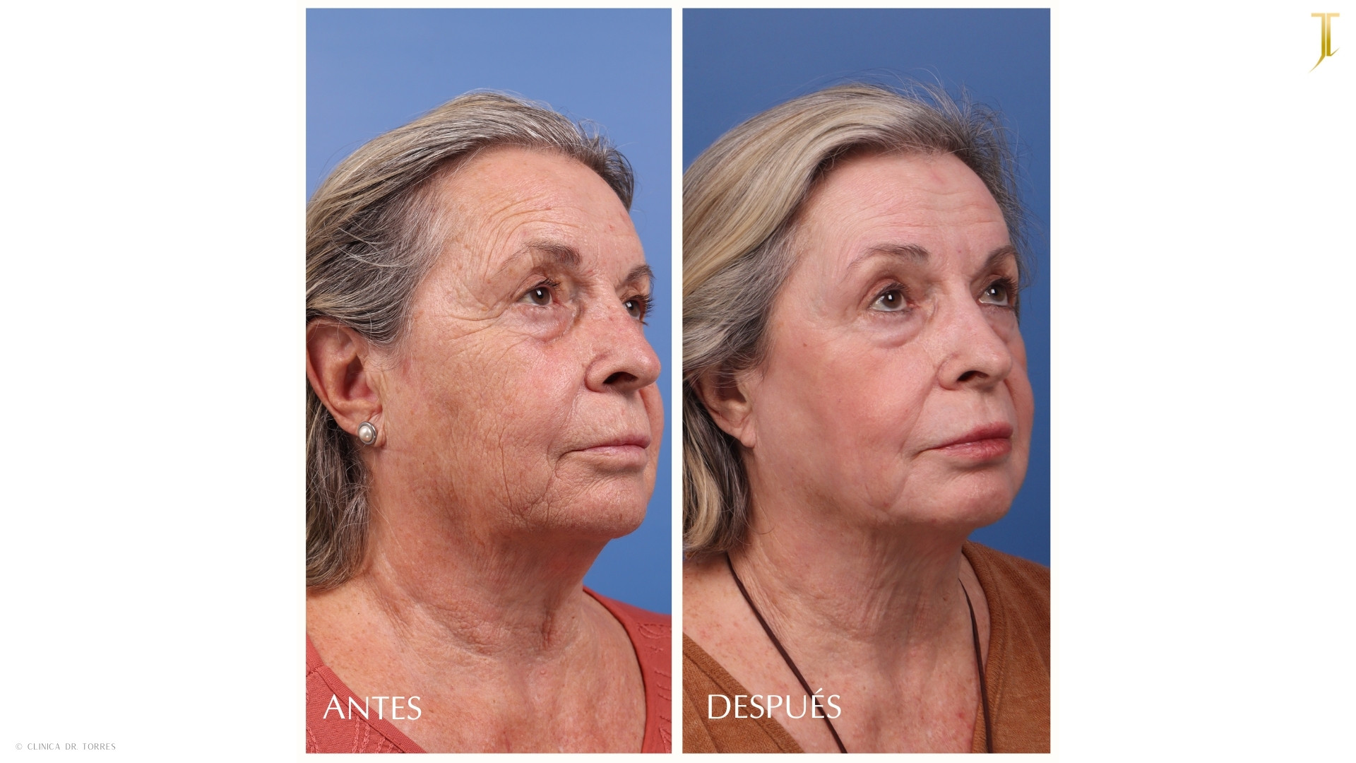 Peeling Profundo. Medicina y Cirugía Estética Facial y Corporal en Valencia Dr. Jorge Torres