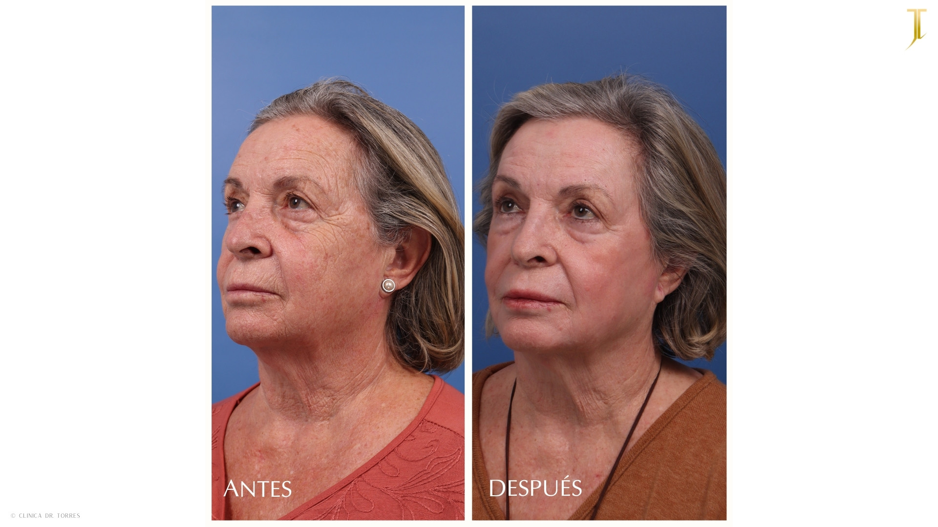 Peeling Profundo. Medicina y Cirugía Estética Facial y Corporal en Valencia Dr. Jorge Torres