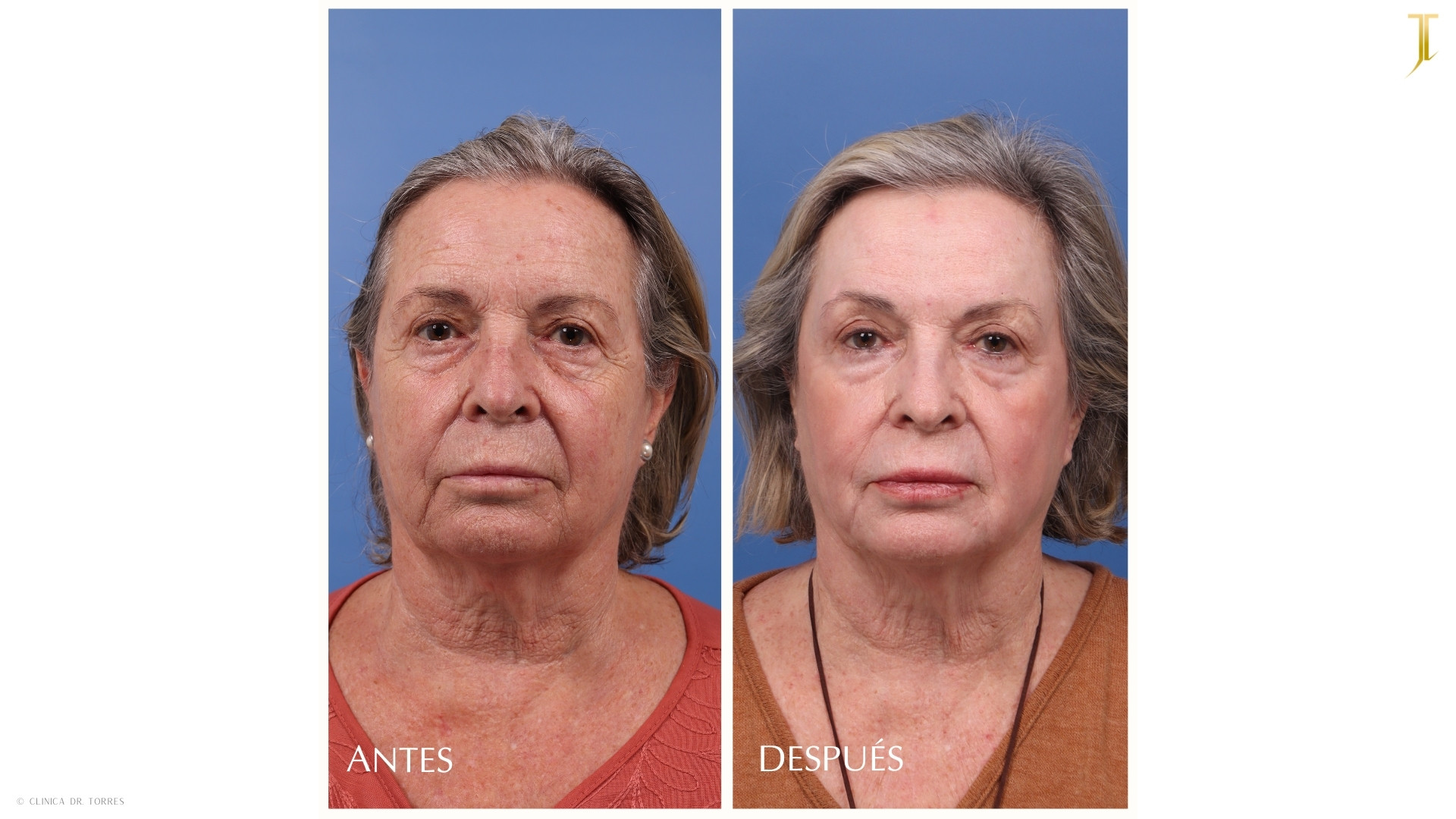 Peeling Profundo. Medicina y Cirugía Estética Facial y Corporal en Valencia Dr. Jorge Torres