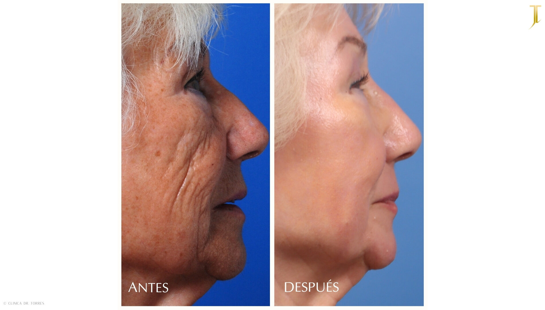 Peeling Profundo. Medicina y Cirugía Estética Facial y Corporal en Valencia Dr. Jorge Torres