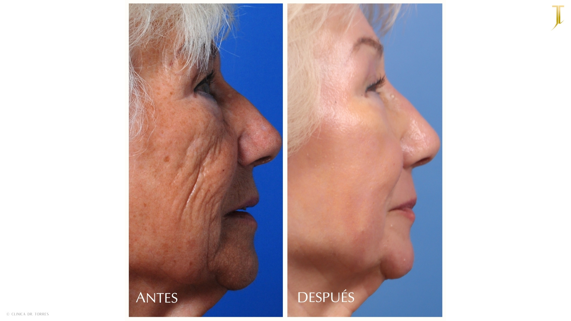 Peeling Profundo. Medicina y Cirugía Estética Facial y Corporal en Valencia Dr. Jorge Torres