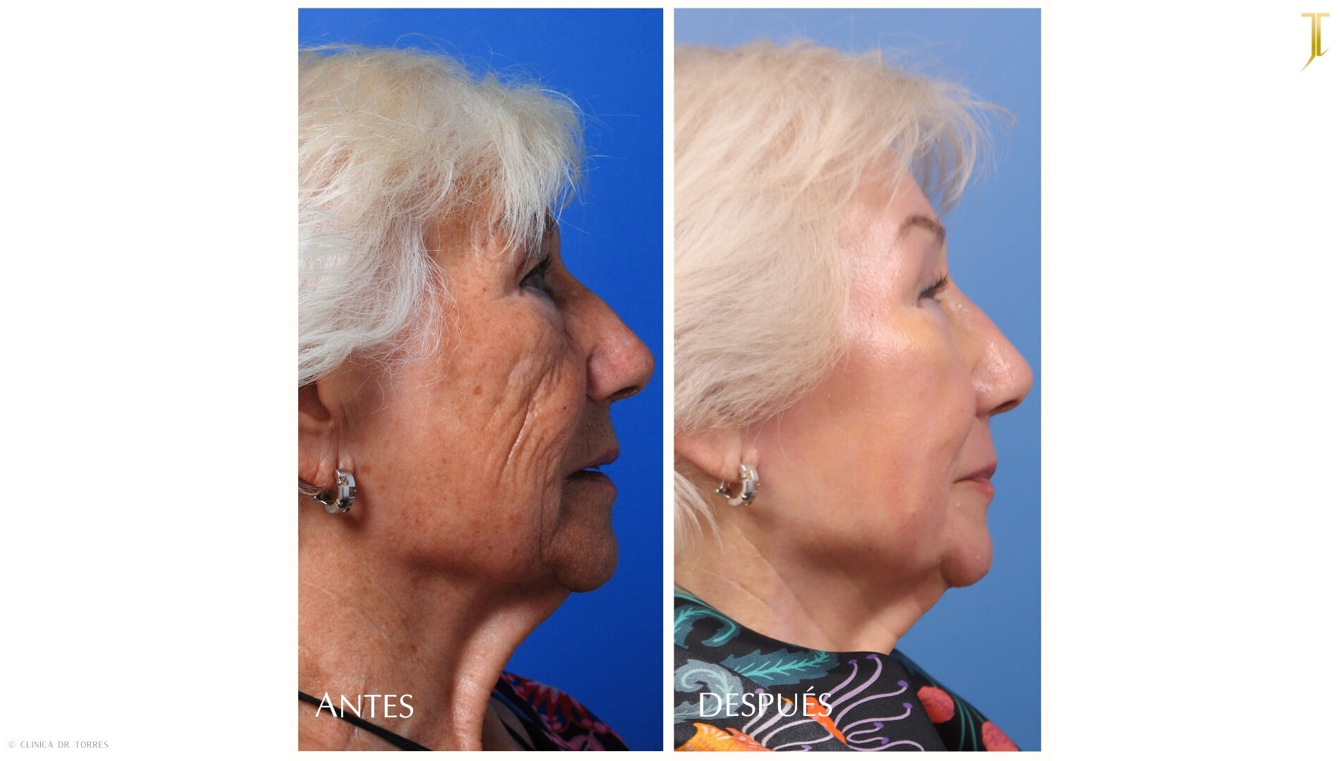 Peeling Profundo. Medicina y Cirugía Estética Facial y Corporal en Valencia Dr. Jorge Torres