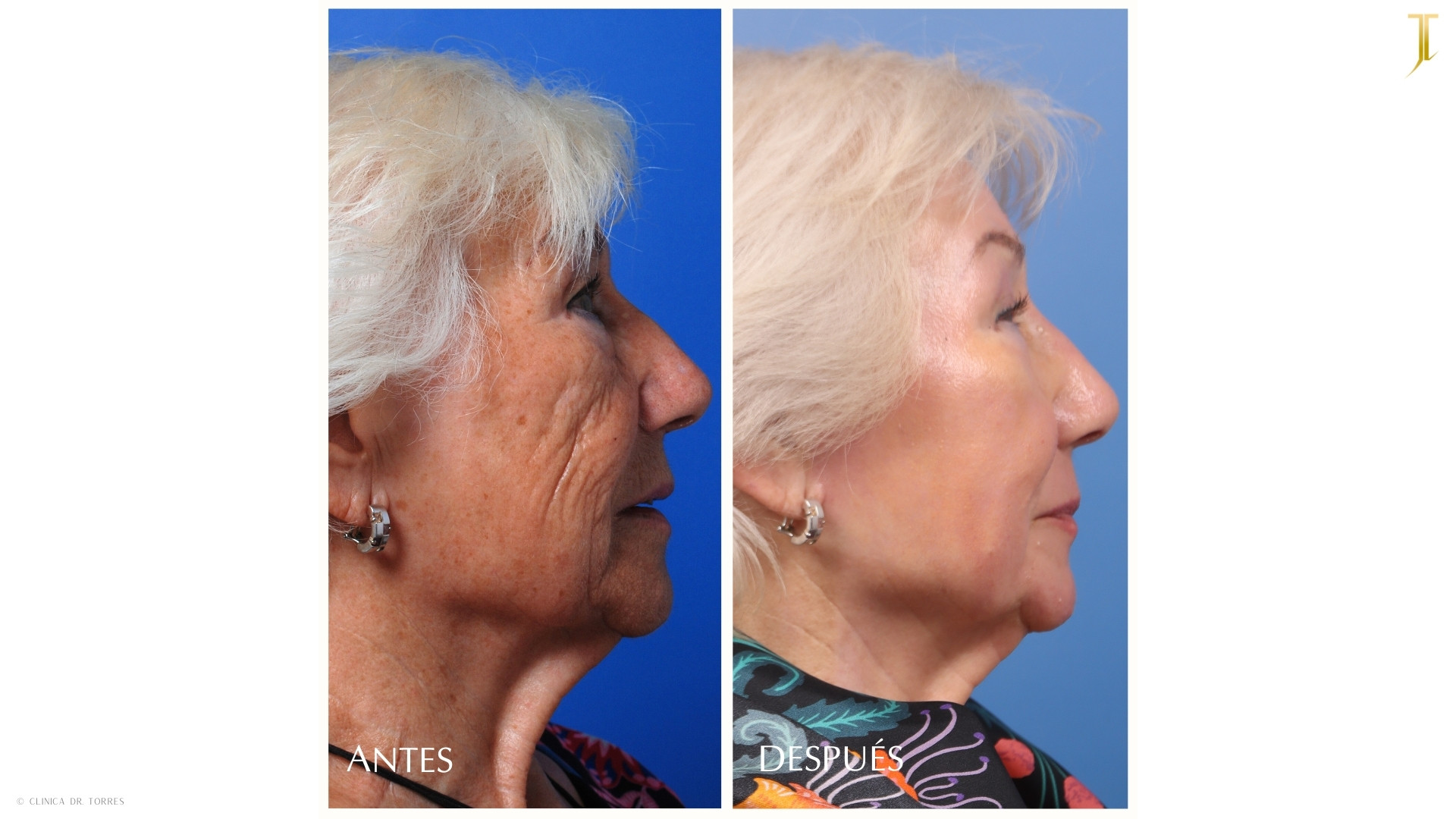 Peeling Profundo. Medicina y Cirugía Estética Facial y Corporal en Valencia Dr. Jorge Torres