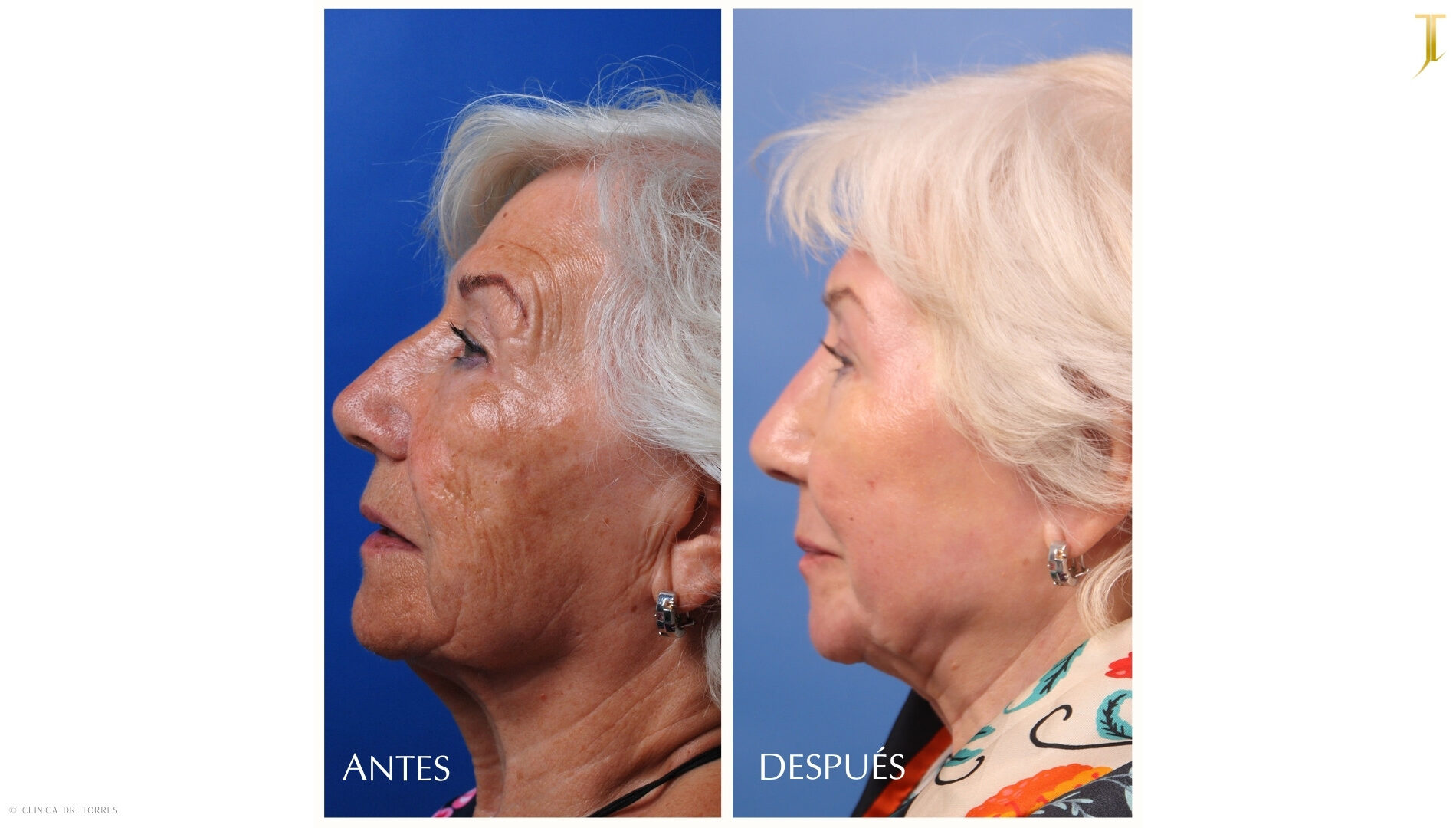 Peeling Profundo. Medicina y Cirugía Estética Facial y Corporal en Valencia Dr. Jorge Torres