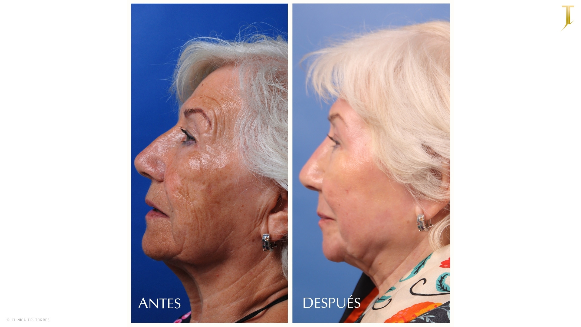 Peeling Profundo. Medicina y Cirugía Estética Facial y Corporal en Valencia Dr. Jorge Torres