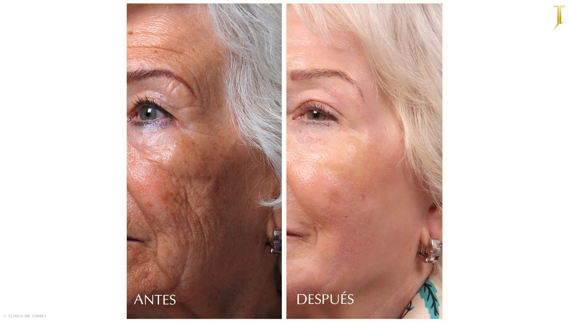 Peeling Profundo. Medicina y Cirugía Estética Facial y Corporal en Valencia Dr. Jorge Torres