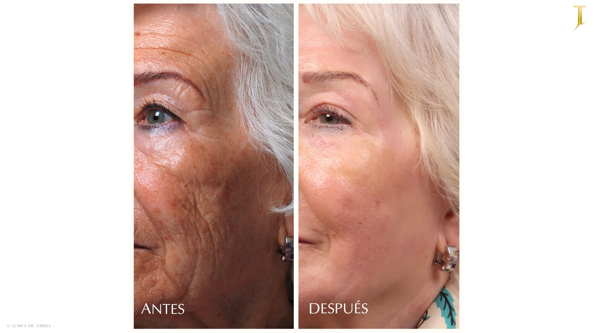 Peeling Profundo. Medicina y Cirugía Estética Facial y Corporal en Valencia Dr. Jorge Torres