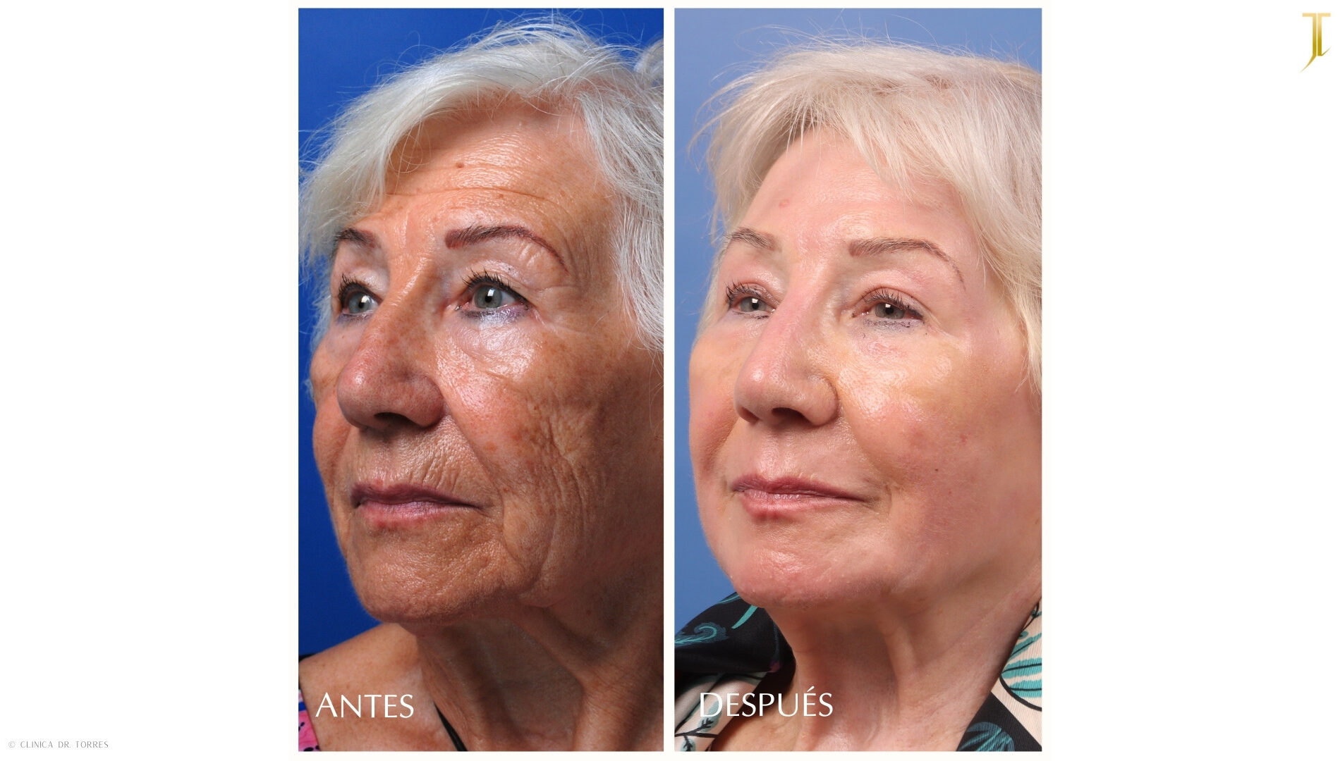 Peeling Profundo. Medicina y Cirugía Estética Facial y Corporal en Valencia Dr. Jorge Torres