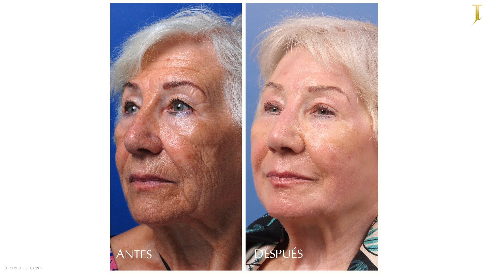 Peeling Profundo. Medicina y Cirugía Estética Facial y Corporal en Valencia Dr. Jorge Torres