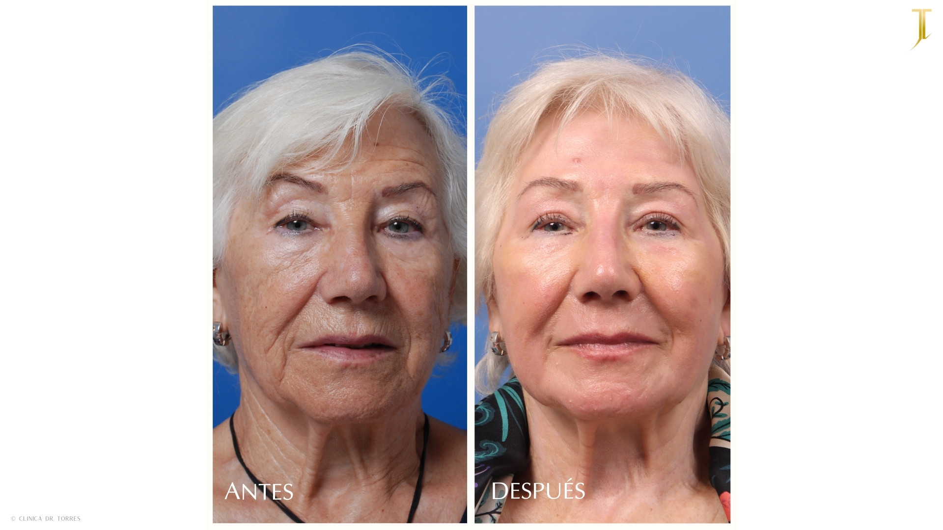 Peeling Profundo. Medicina y Cirugía Estética Facial y Corporal en Valencia Dr. Jorge Torres