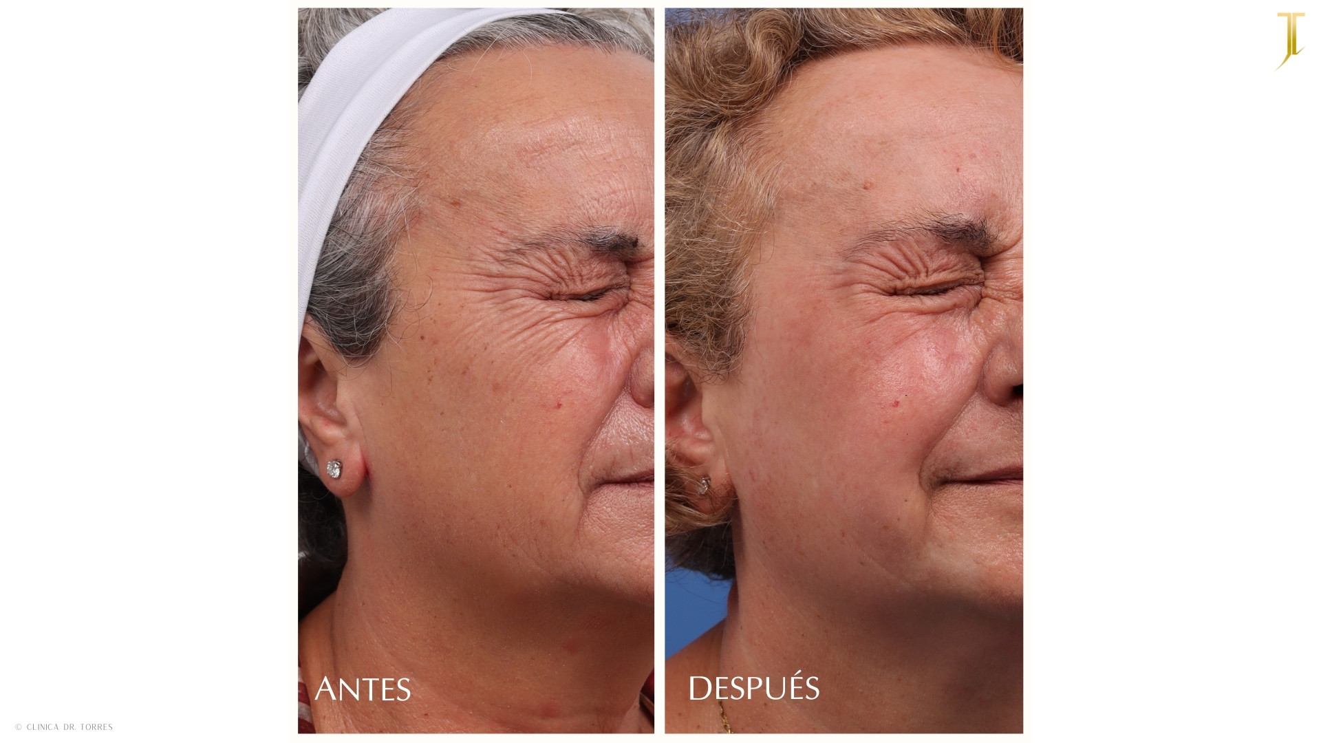 Peeling Profundo. Medicina y Cirugía Estética Facial y Corporal en Valencia Dr. Jorge Torres