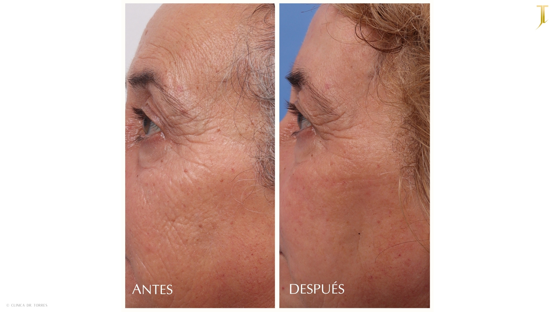 Peeling Profundo. Medicina y Cirugía Estética Facial y Corporal en Valencia Dr. Jorge Torres