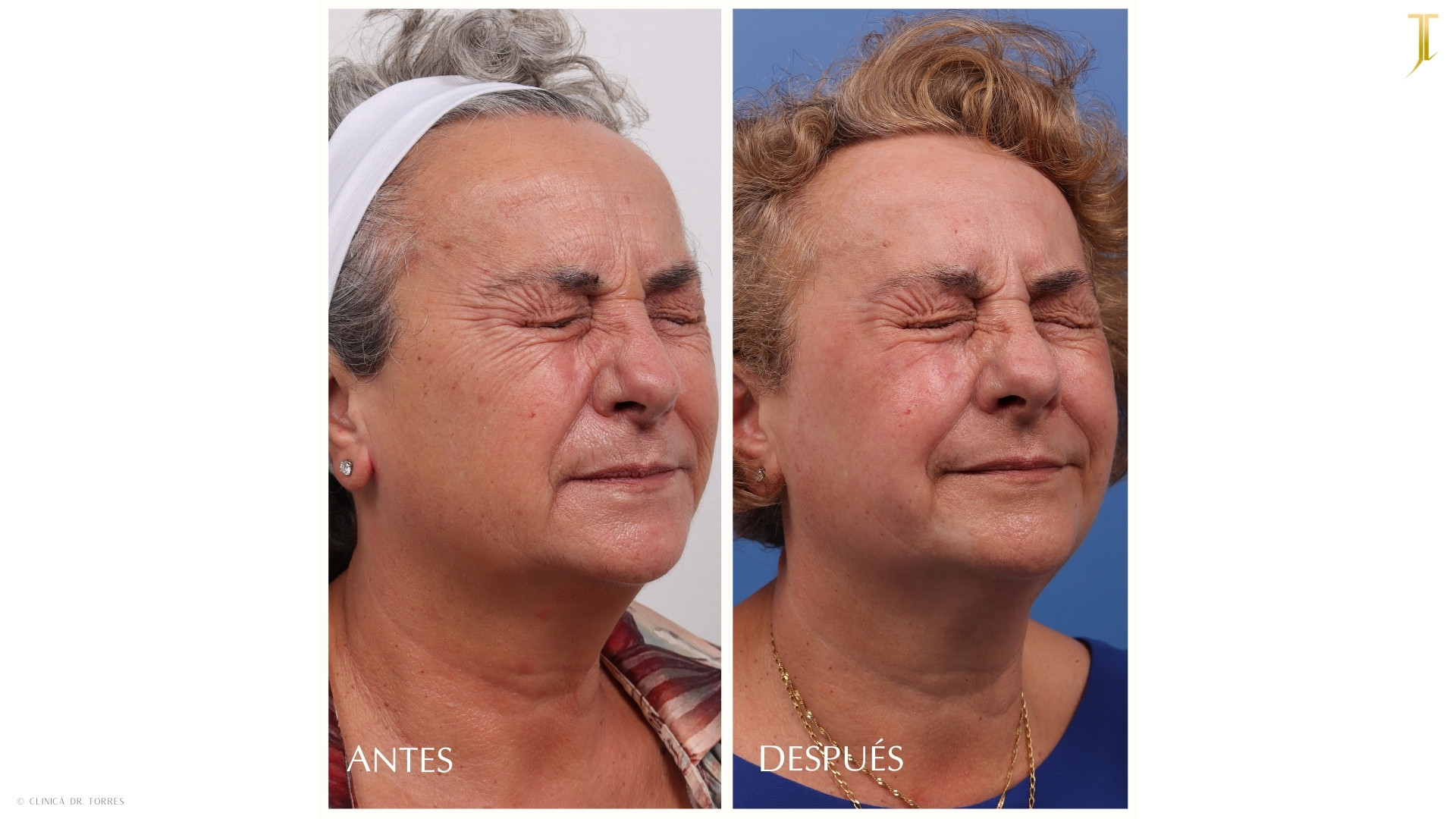 Peeling Profundo. Medicina y Cirugía Estética Facial y Corporal en Valencia Dr. Jorge Torres