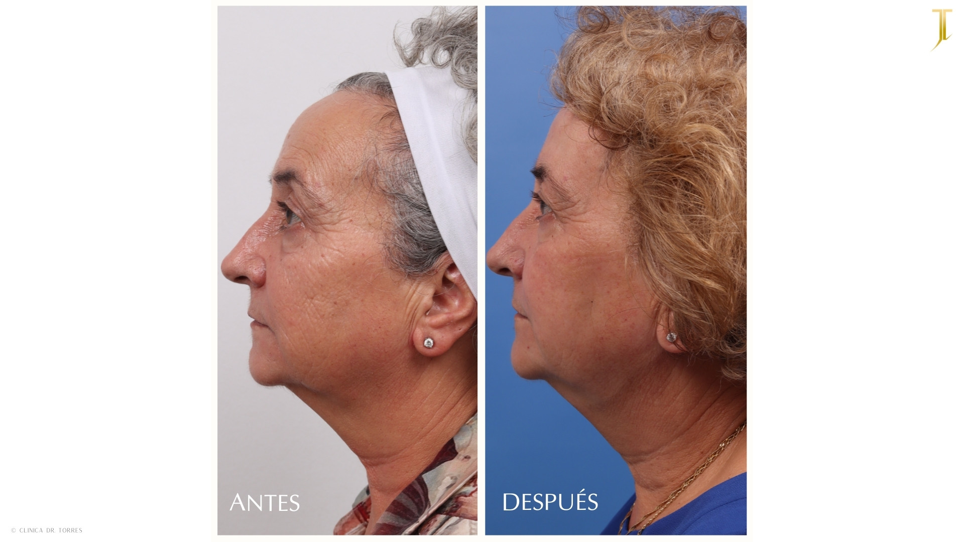 Peeling Profundo. Medicina y Cirugía Estética Facial y Corporal en Valencia Dr. Jorge Torres
