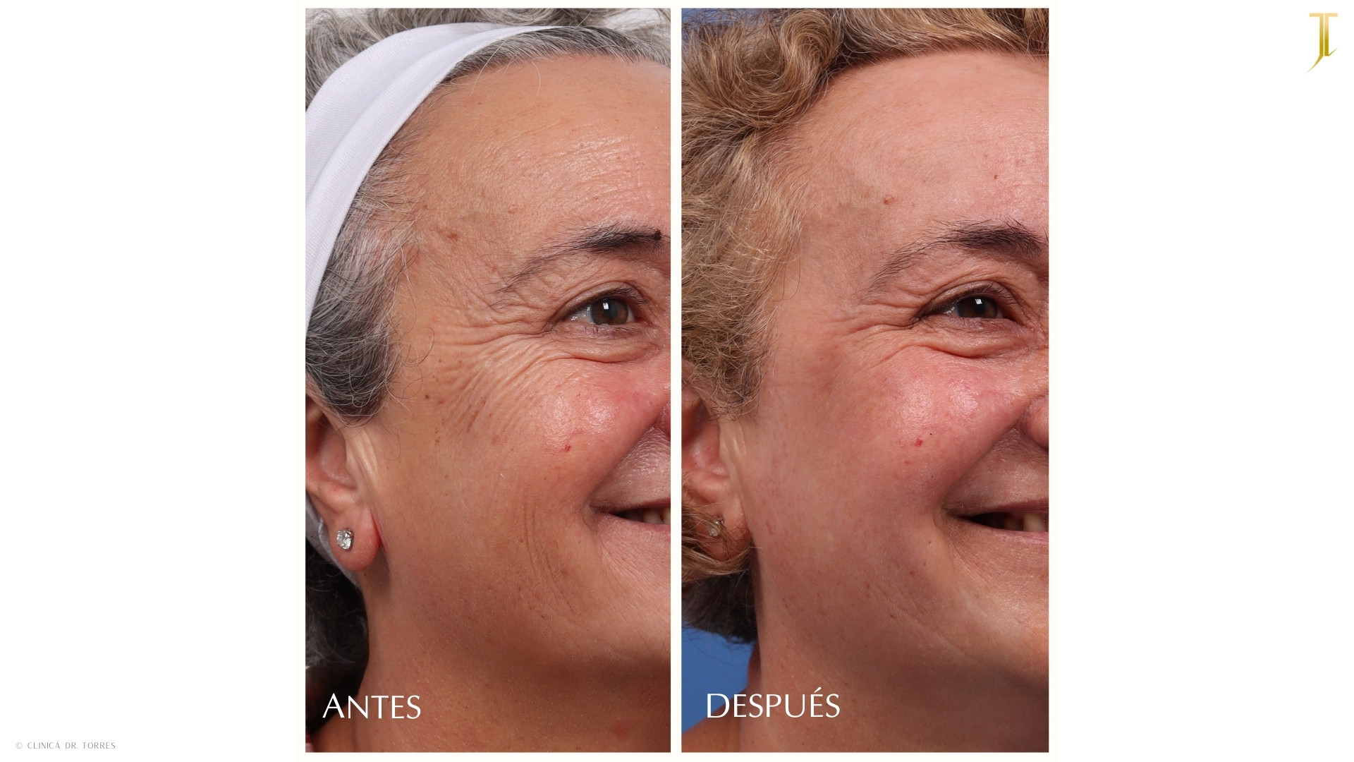 Peeling Profundo. Medicina y Cirugía Estética Facial y Corporal en Valencia Dr. Jorge Torres