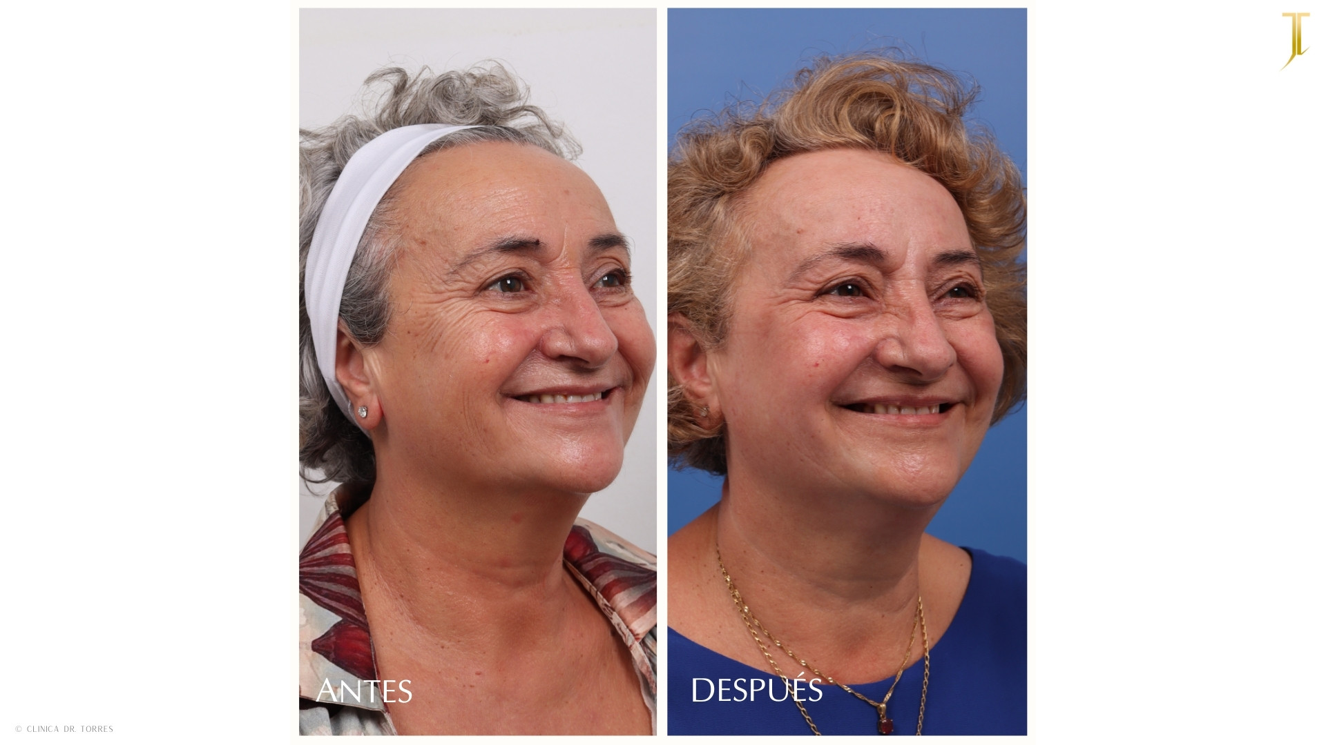 Peeling Profundo. Medicina y Cirugía Estética Facial y Corporal en Valencia Dr. Jorge Torres