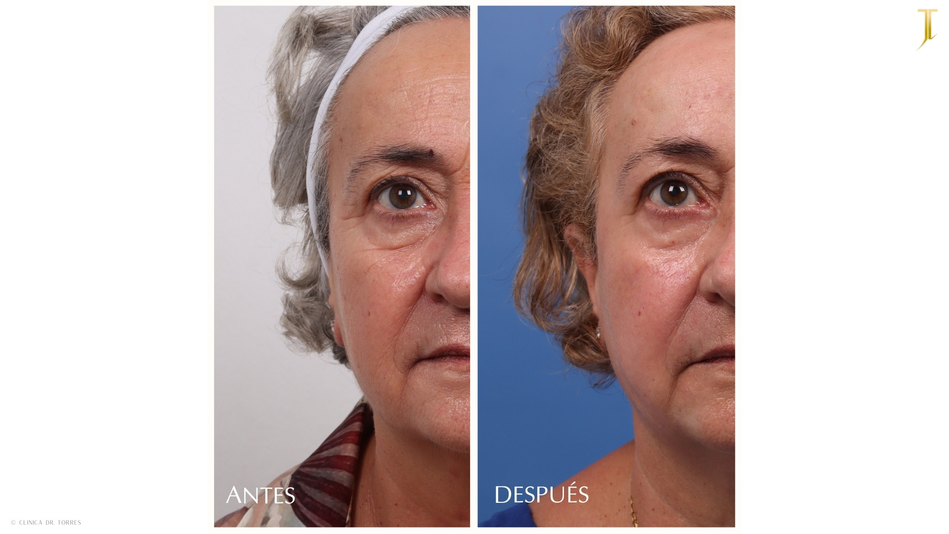Peeling Profundo. Medicina y Cirugía Estética Facial y Corporal en Valencia Dr. Jorge Torres