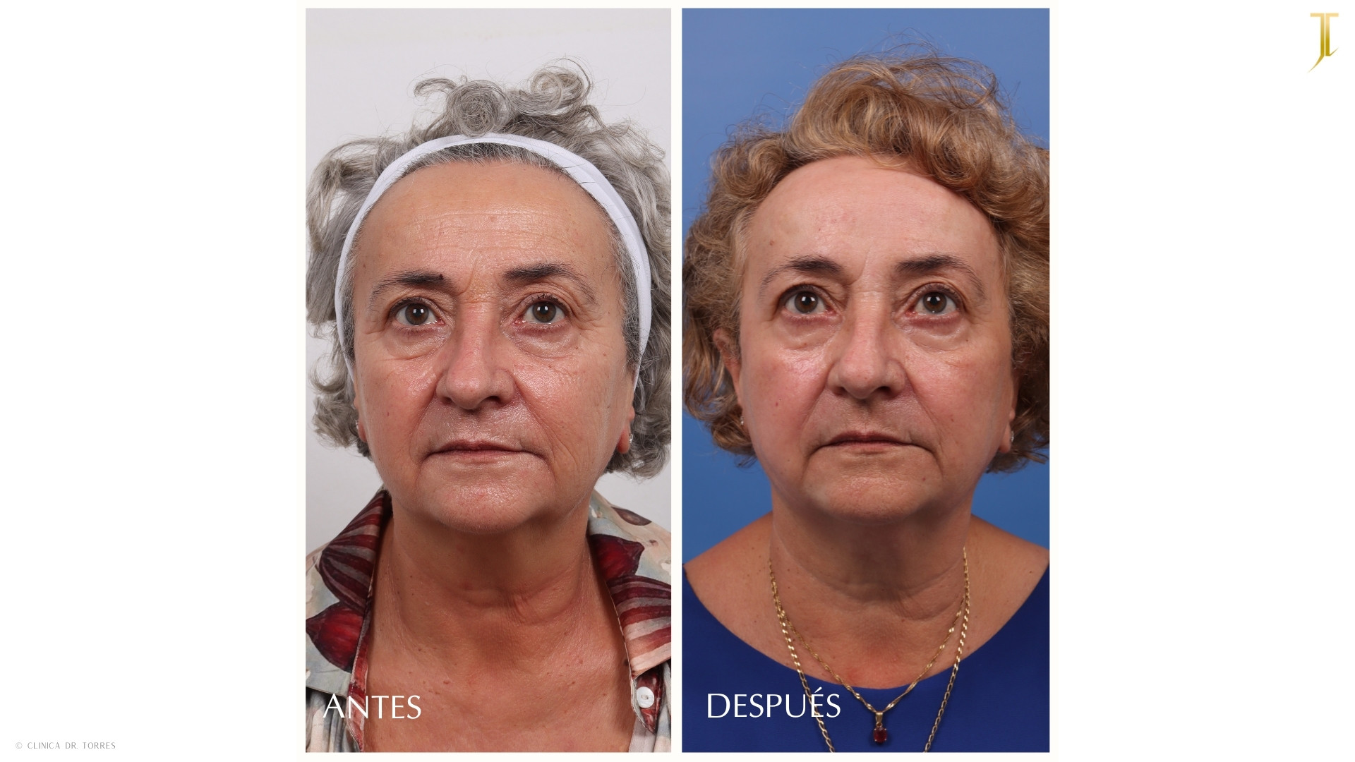 Peeling Profundo. Medicina y Cirugía Estética Facial y Corporal en Valencia Dr. Jorge Torres