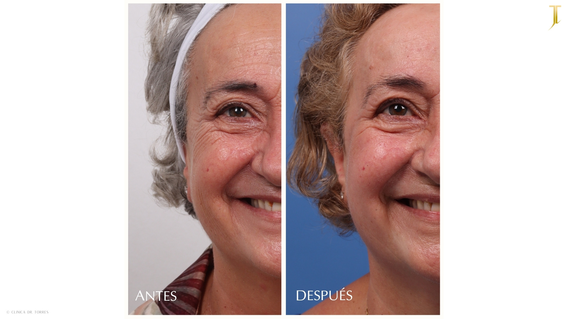 Peeling Profundo. Medicina y Cirugía Estética Facial y Corporal en Valencia Dr. Jorge Torres