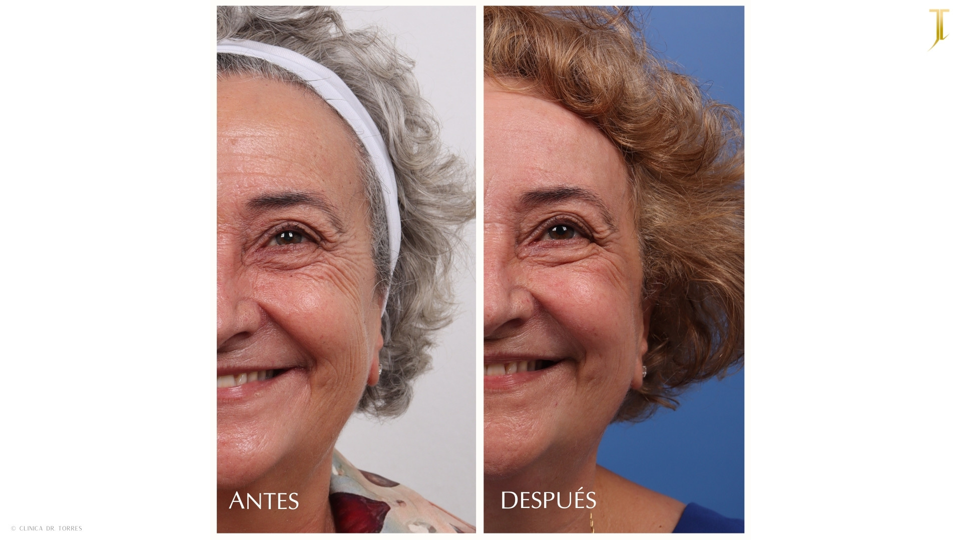 Peeling Profundo. Medicina y Cirugía Estética Facial y Corporal en Valencia Dr. Jorge Torres