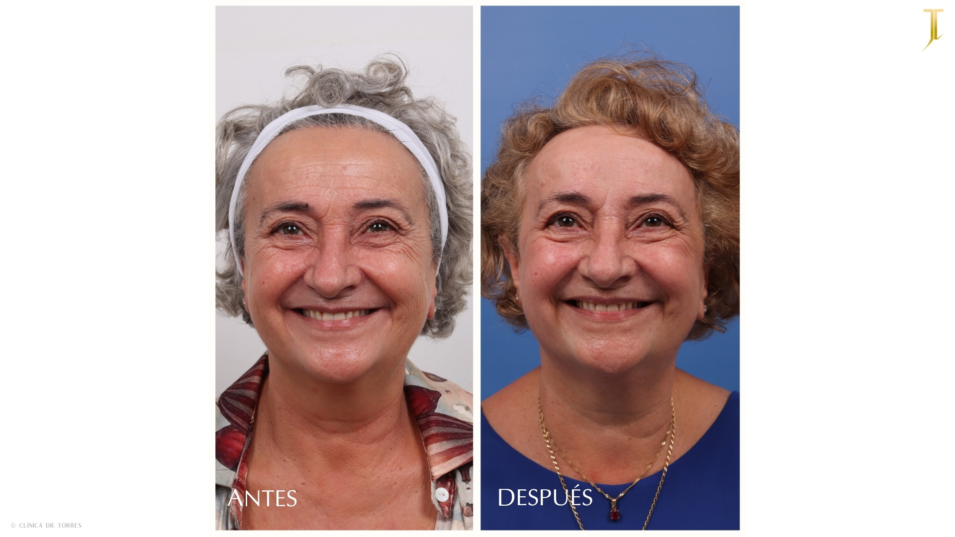 Peeling Profundo. Medicina y Cirugía Estética Facial y Corporal en Valencia Dr. Jorge Torres