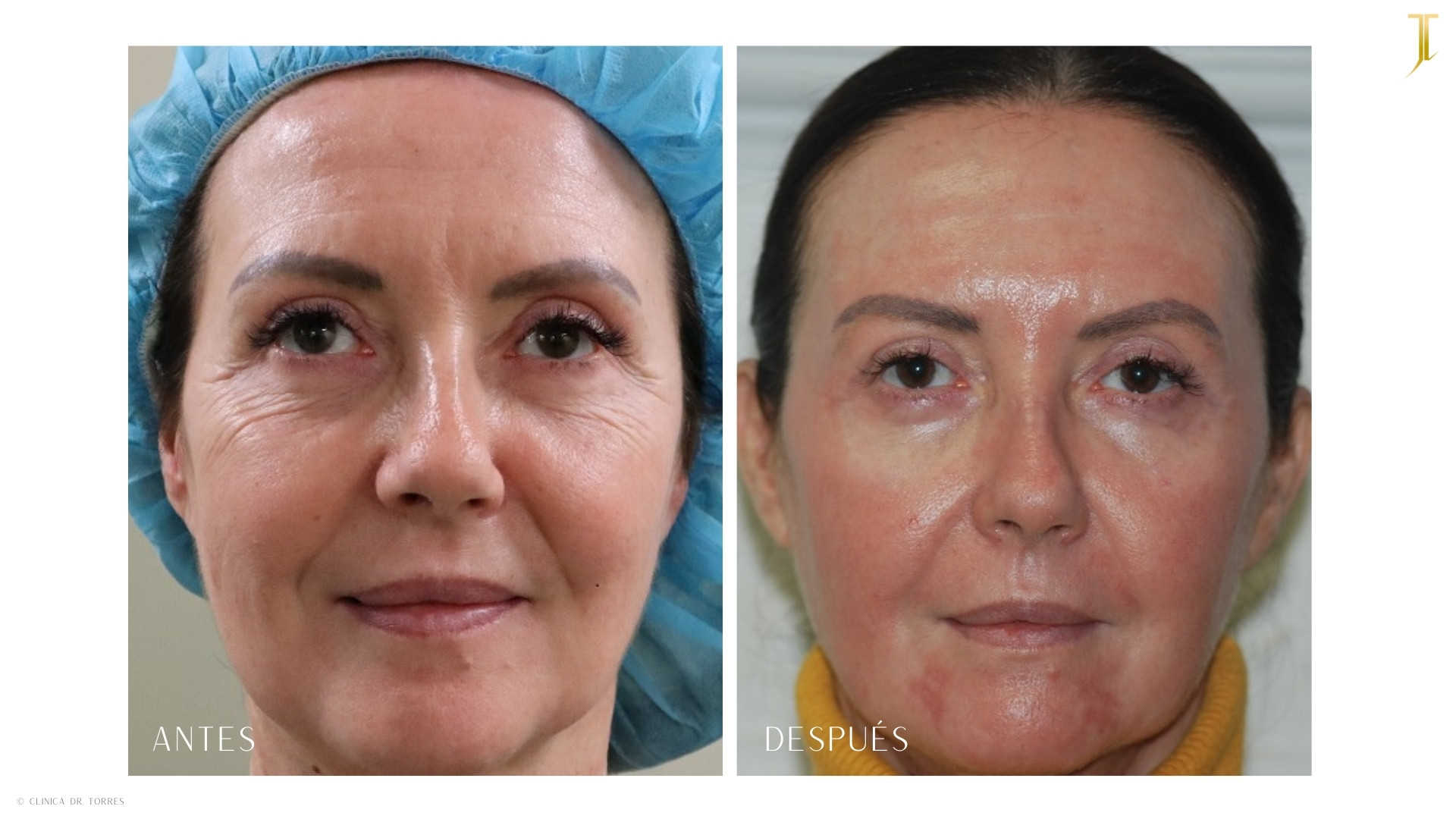 Peeling Profundo. Medicina y Cirugía Estética Facial y Corporal en Valencia Dr. Jorge Torres