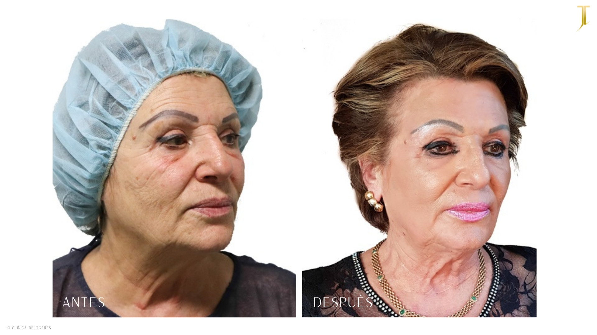 Peeling Profundo. Medicina y Cirugía Estética Facial y Corporal en Valencia Dr. Jorge Torres