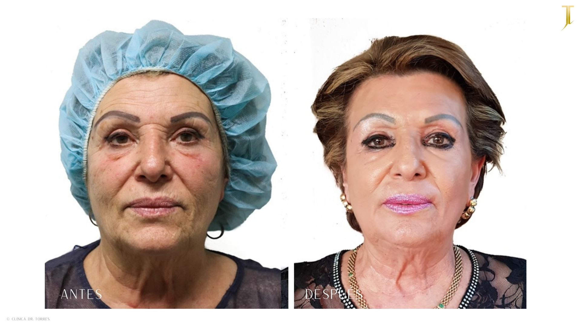 Peeling Profundo. Medicina y Cirugía Estética Facial y Corporal en Valencia Dr. Jorge Torres