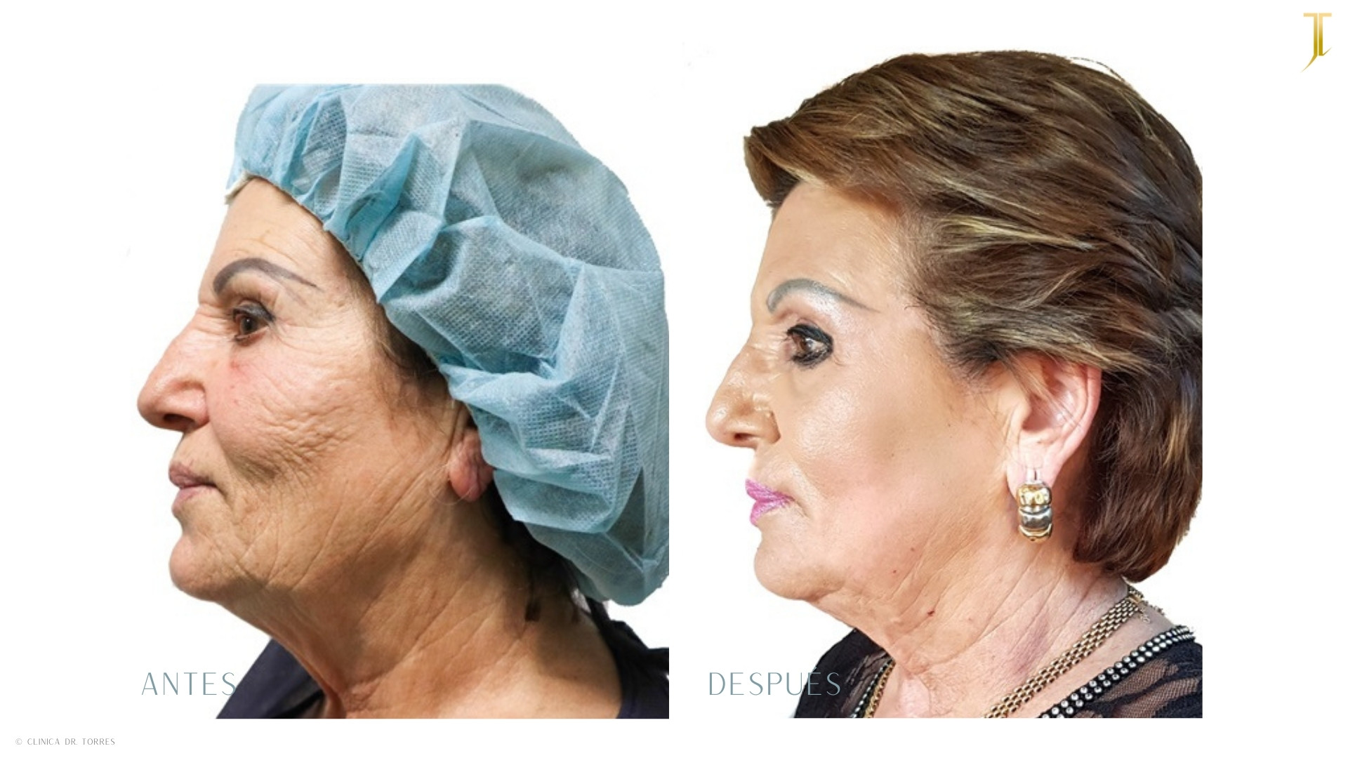 Peeling Profundo. Medicina y Cirugía Estética Facial y Corporal en Valencia Dr. Jorge Torres
